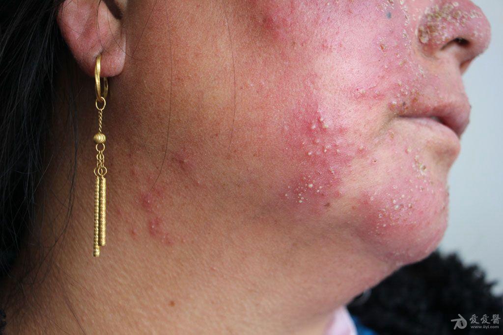 2015年皮肤版有奖病例猜答51答案毛囊螨皮炎伴激素皮炎