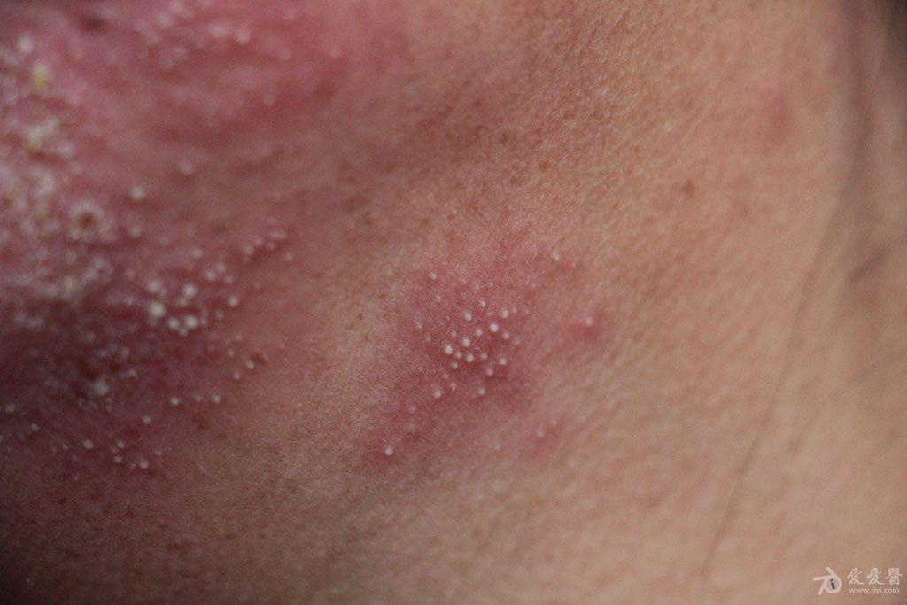 2015年皮肤版有奖病例猜答51答案毛囊螨皮炎伴激素皮炎