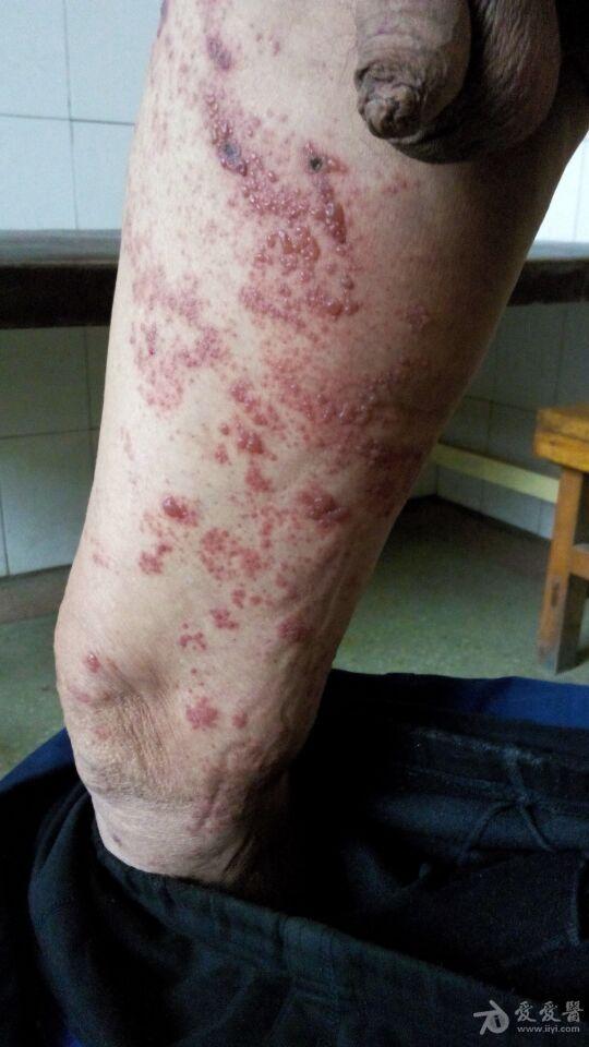 老年带状疱疹的临床治疗路径