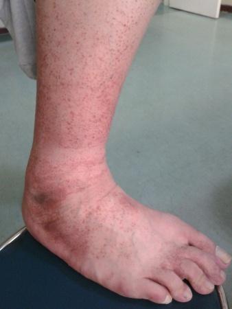 典型病例 进行性色素性紫癜性皮肤病 皮肤及性传播疾病讨论版 爱爱医医学论坛