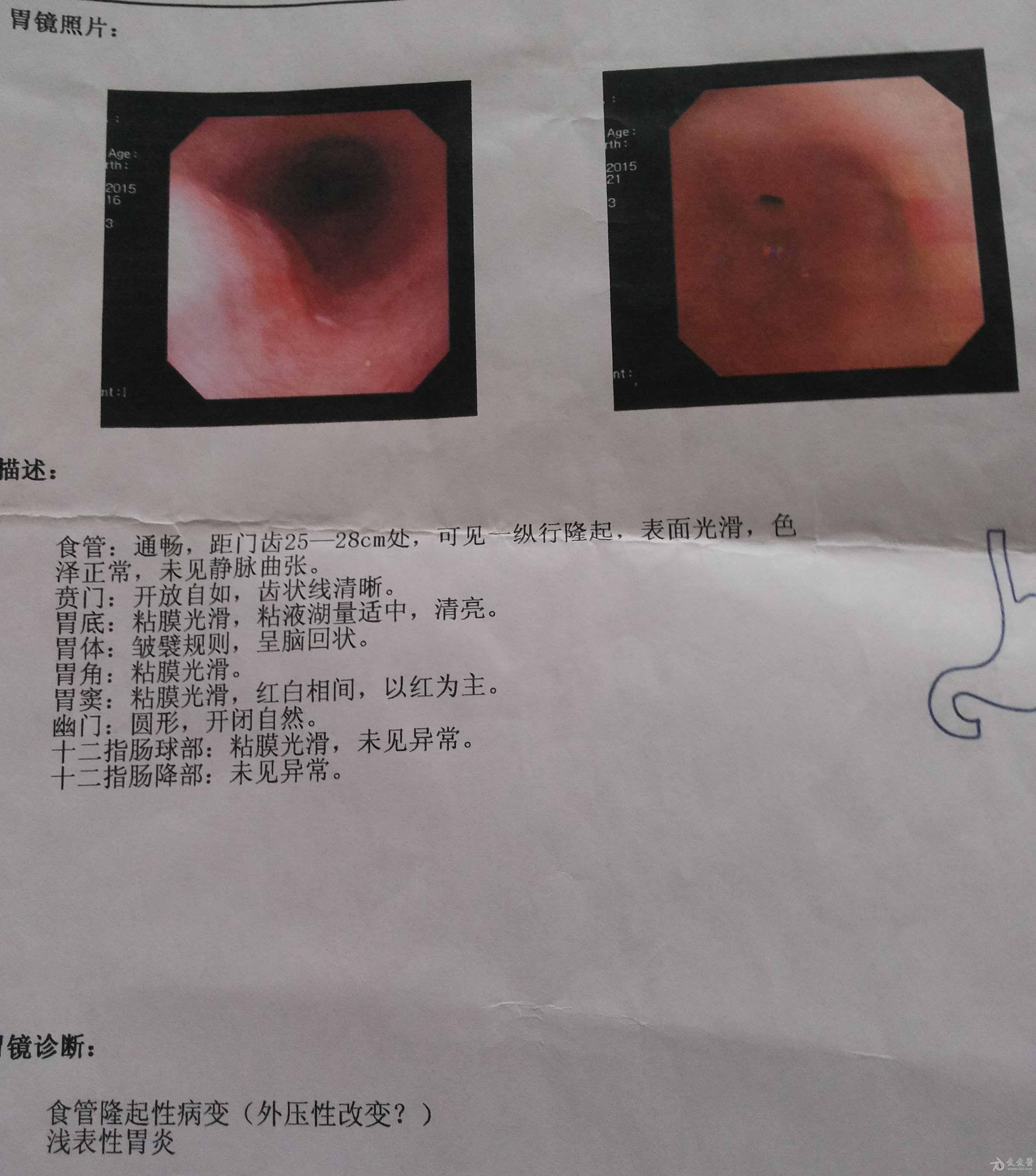 食管粘膜隆起图片