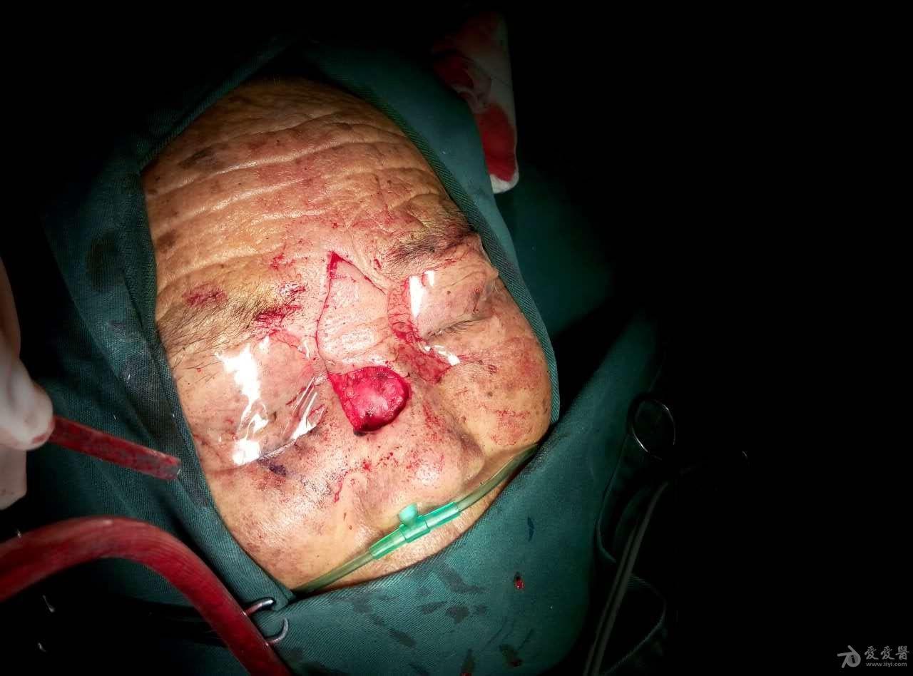 鼻部基底细胞癌切除后皮瓣修复