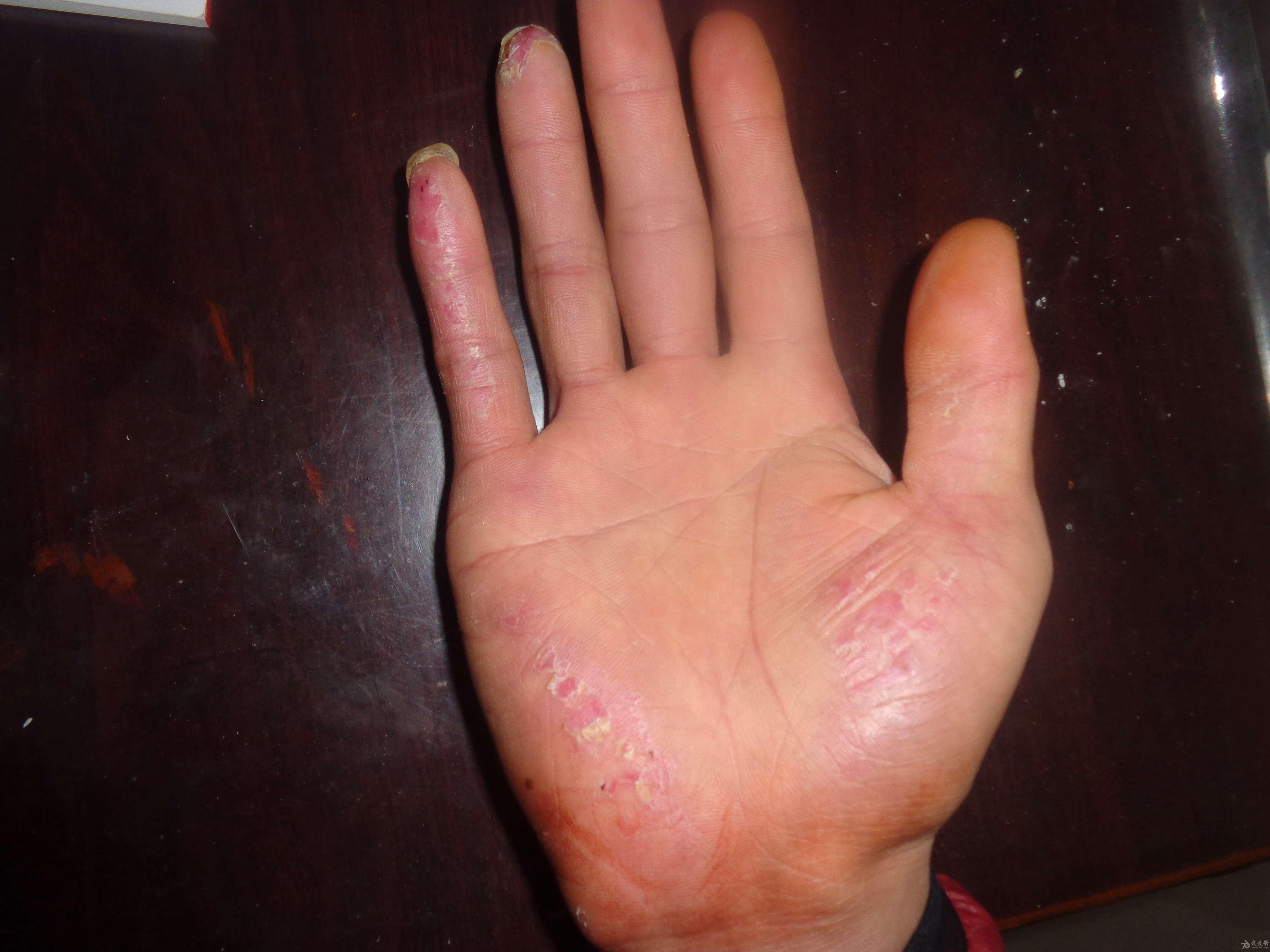 手脱皮最佳治疗方法图片