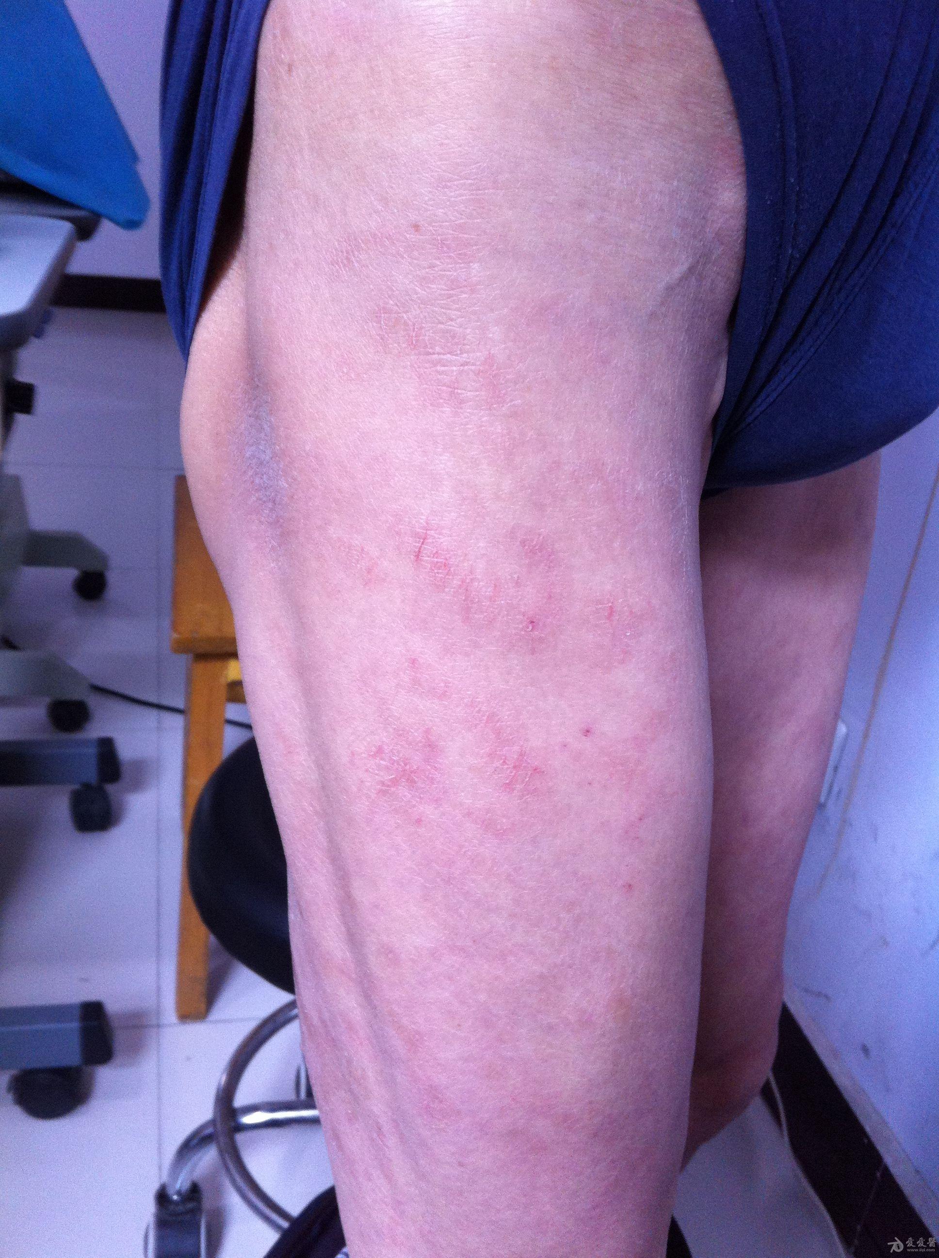 皮肤病一例请大家诊断