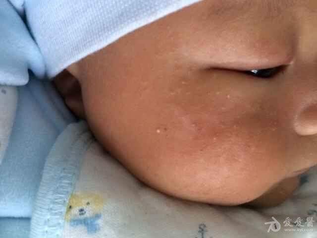 婴儿小米粒丘疹图片图片