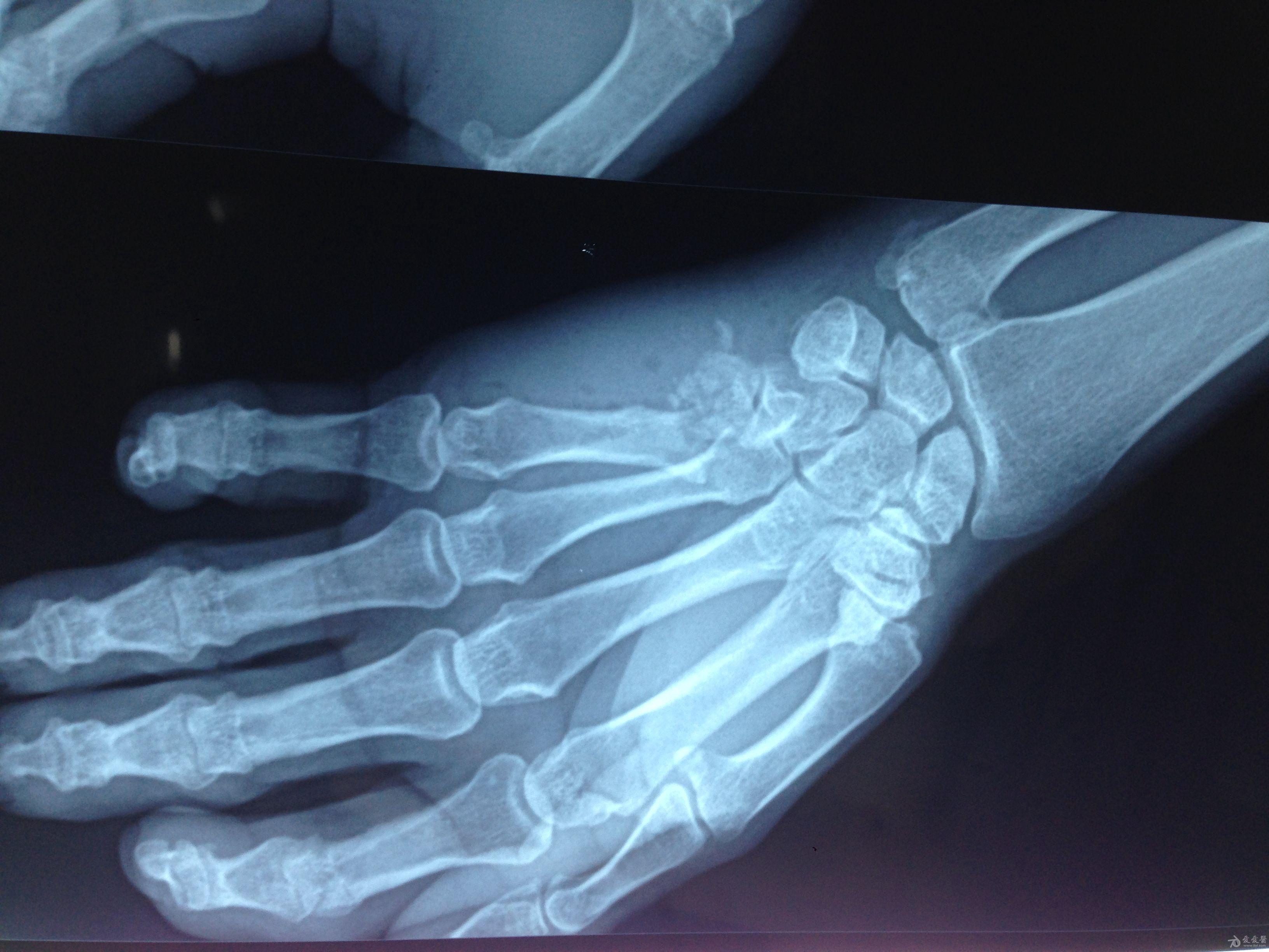 左手掌第5掌骨基底部粉碎性骨折