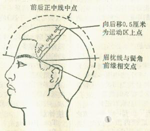 中医中药区 69 中医基础版 69 头皮针   如张辉针刺双侧晕听区