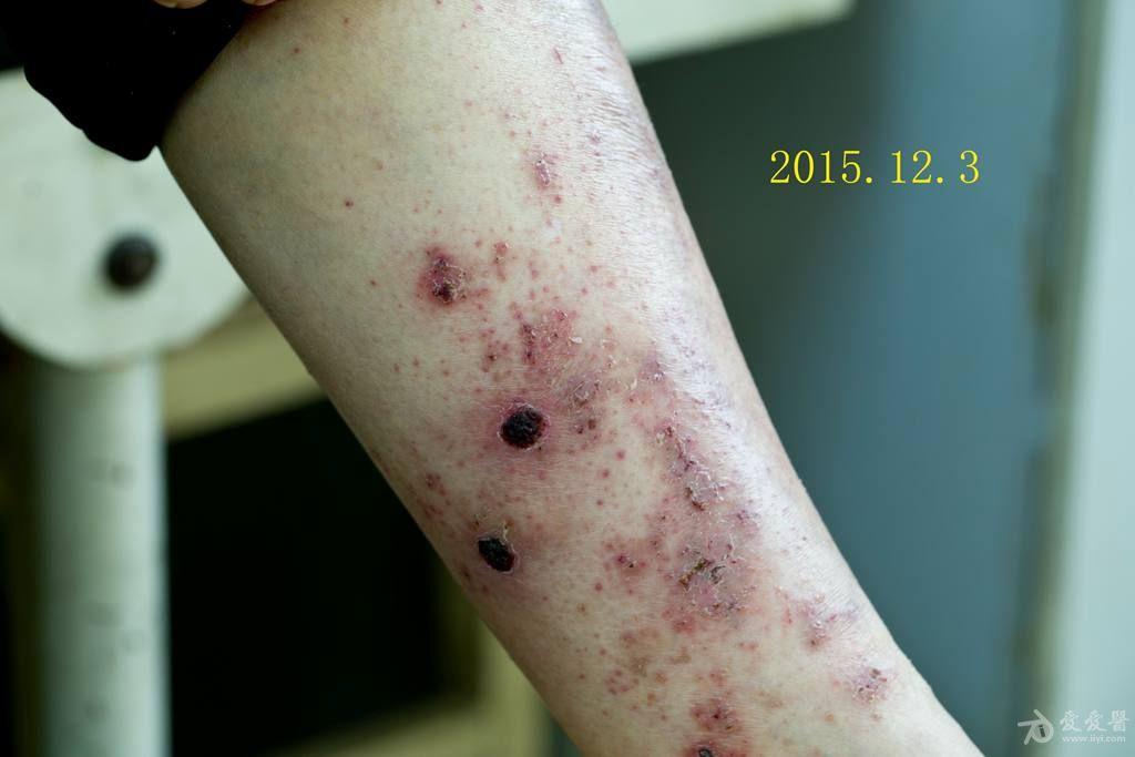 前泛发湿疹一例治疗6天后的图片