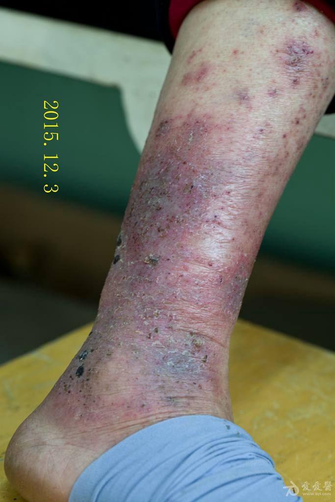 前泛发湿疹一例治疗6天后的图片