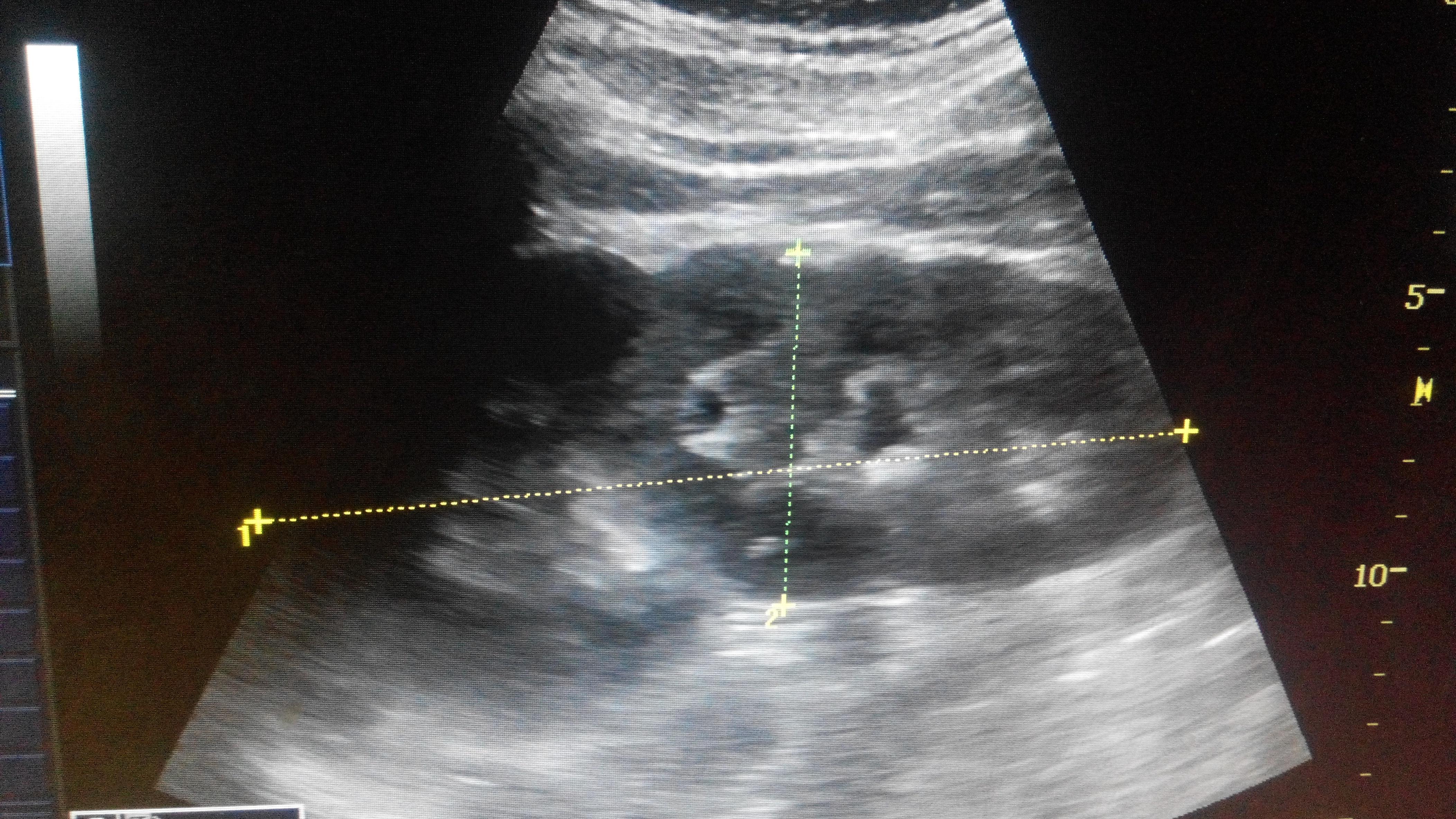 彩超重复肾声像图片图片