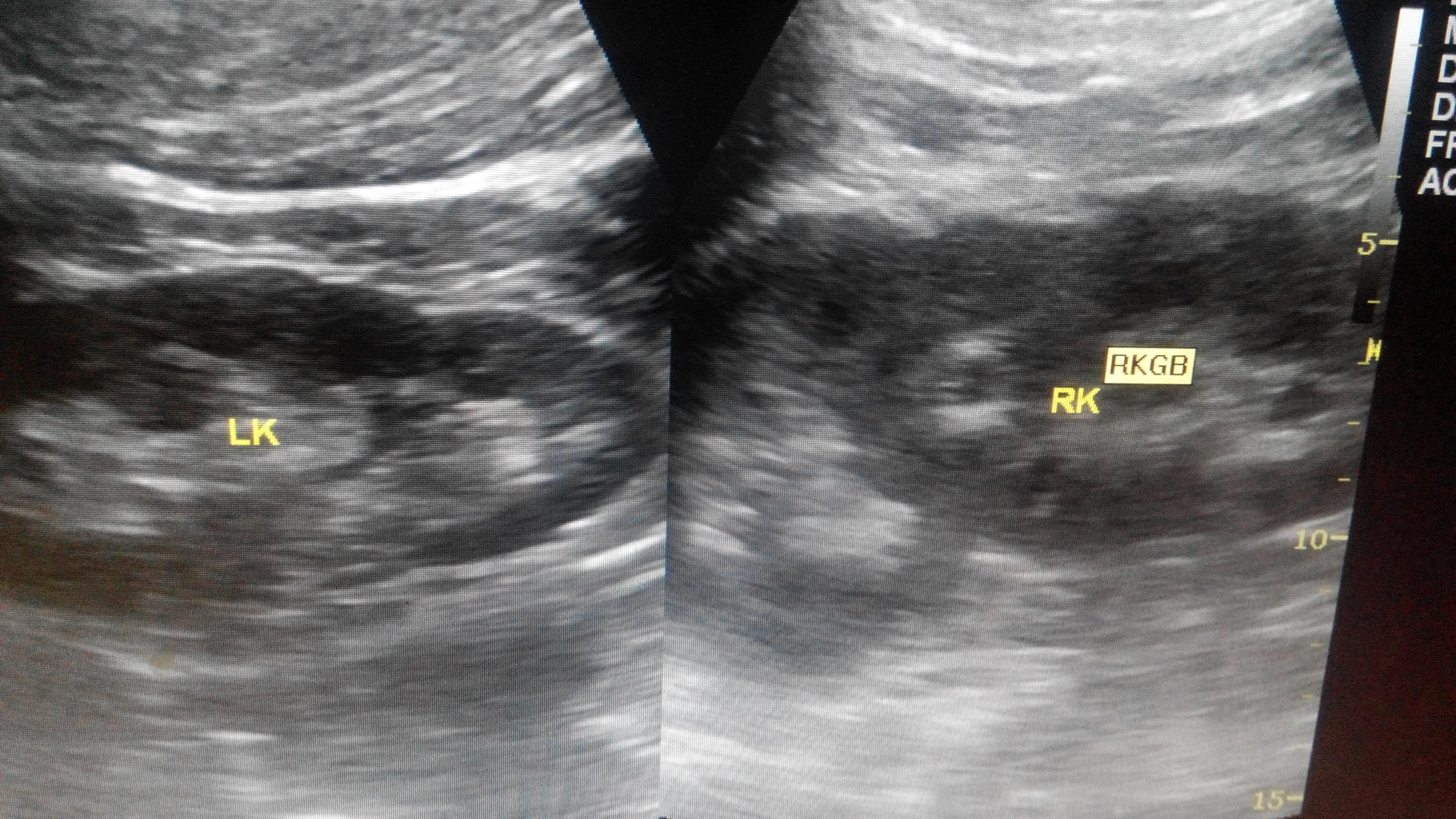 彩超重复肾声像图片图片