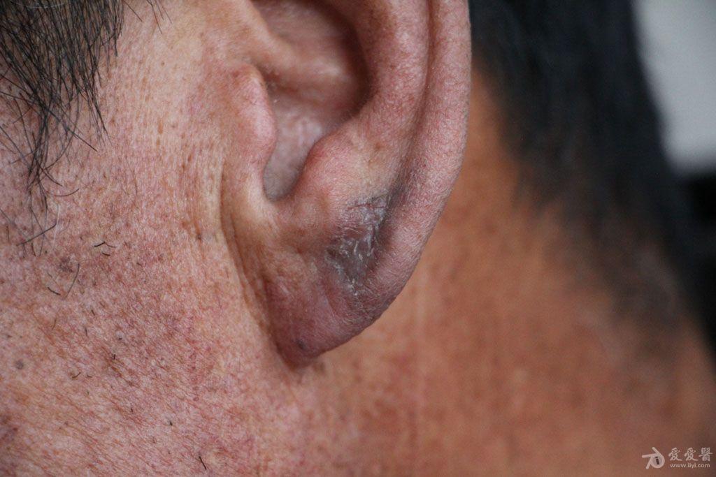 2015年皮肤版有奖病例猜答54答案扁平苔藓