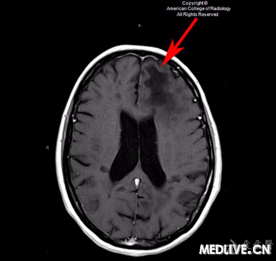 ms病情为什么恶化答案后续