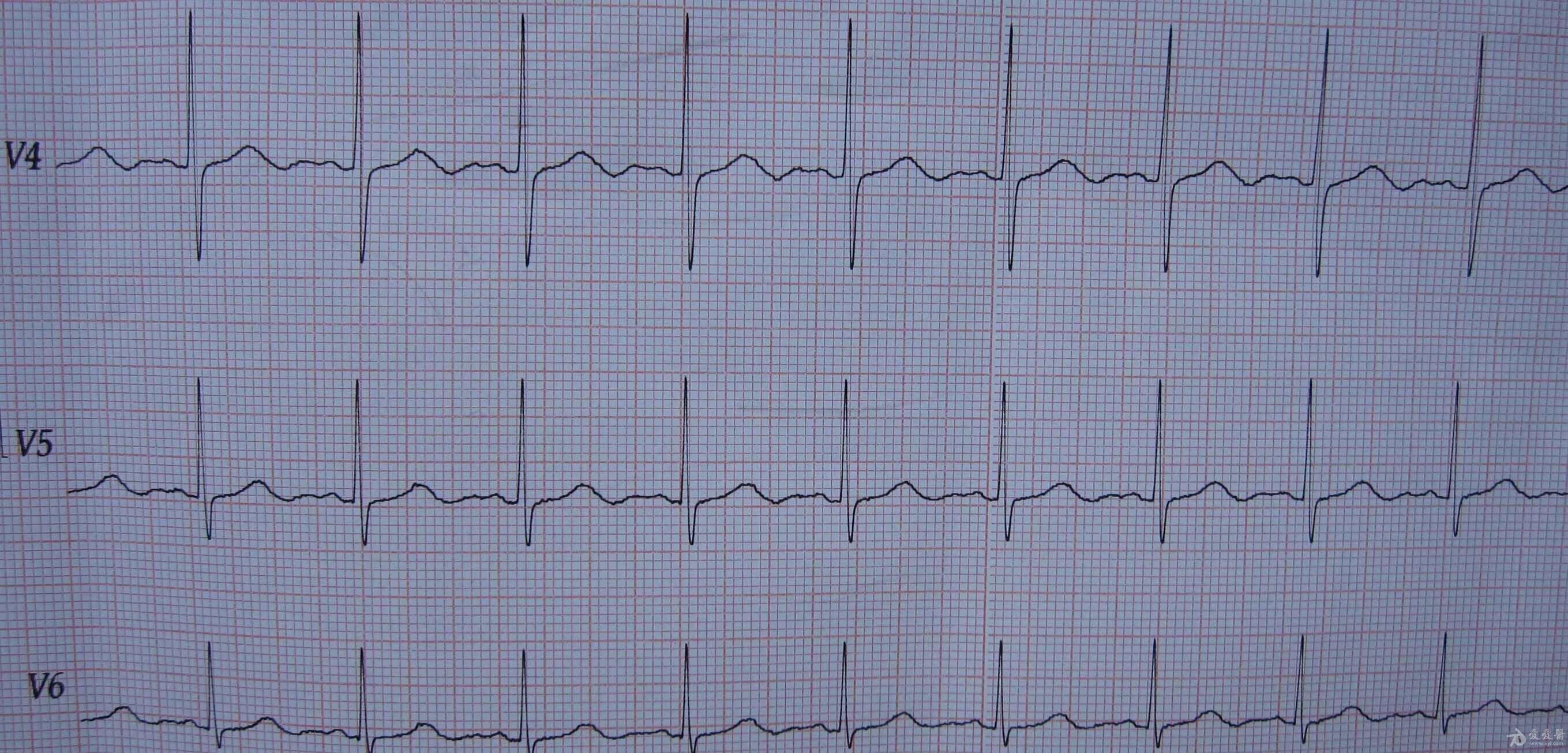 心电图电压高图片