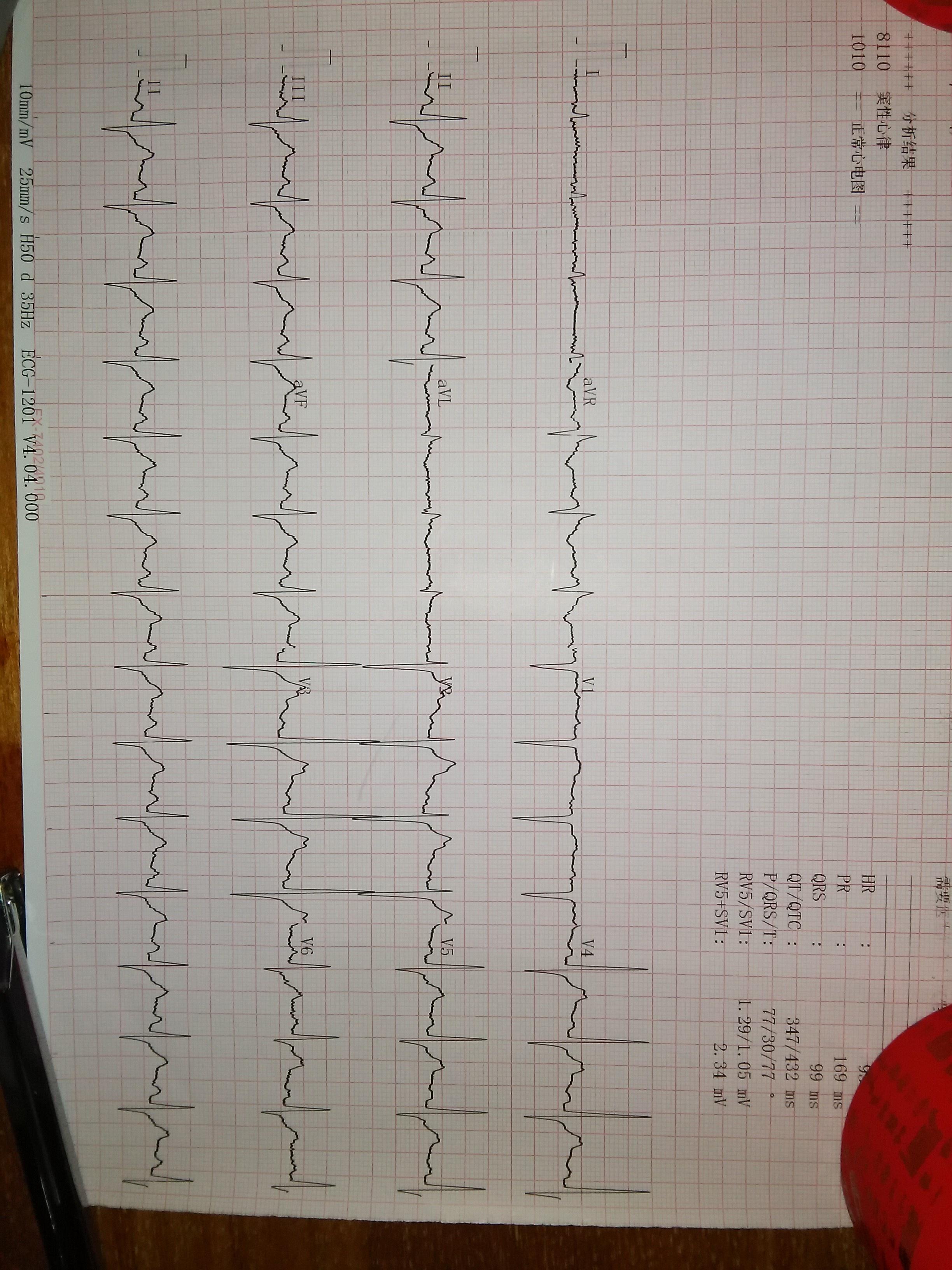 正常心电图v1导联t波图片