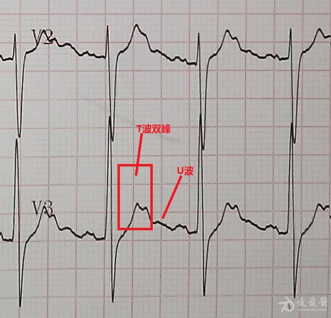 麻煩各位老師看下胸導聯的t波像不像tu融合