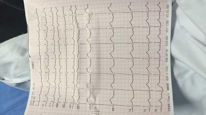 st段異常改變?心梗? - 心電圖腦電圖專業討論版 - 愛愛醫醫學論壇