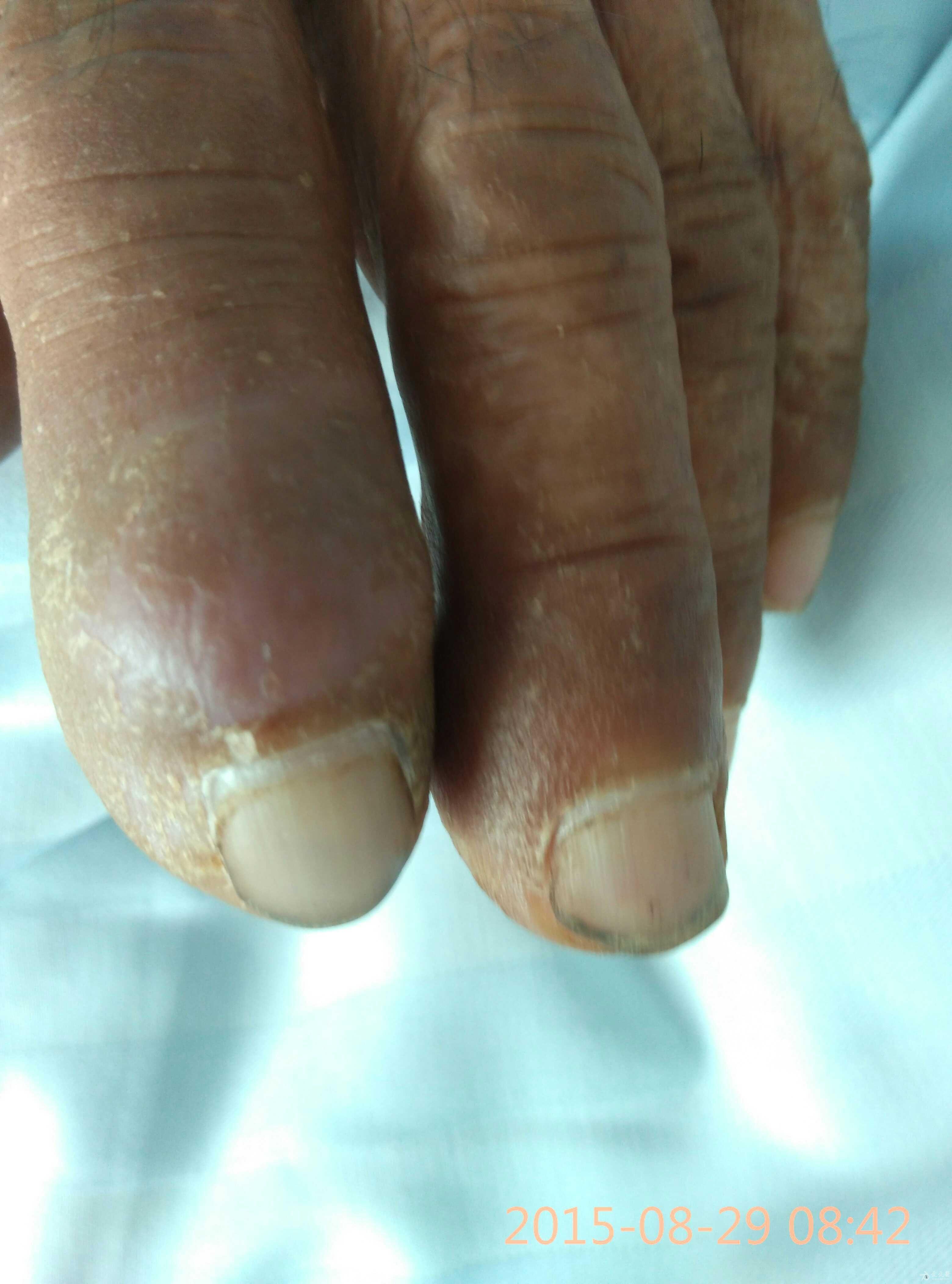 杵状指趾早期图片图片