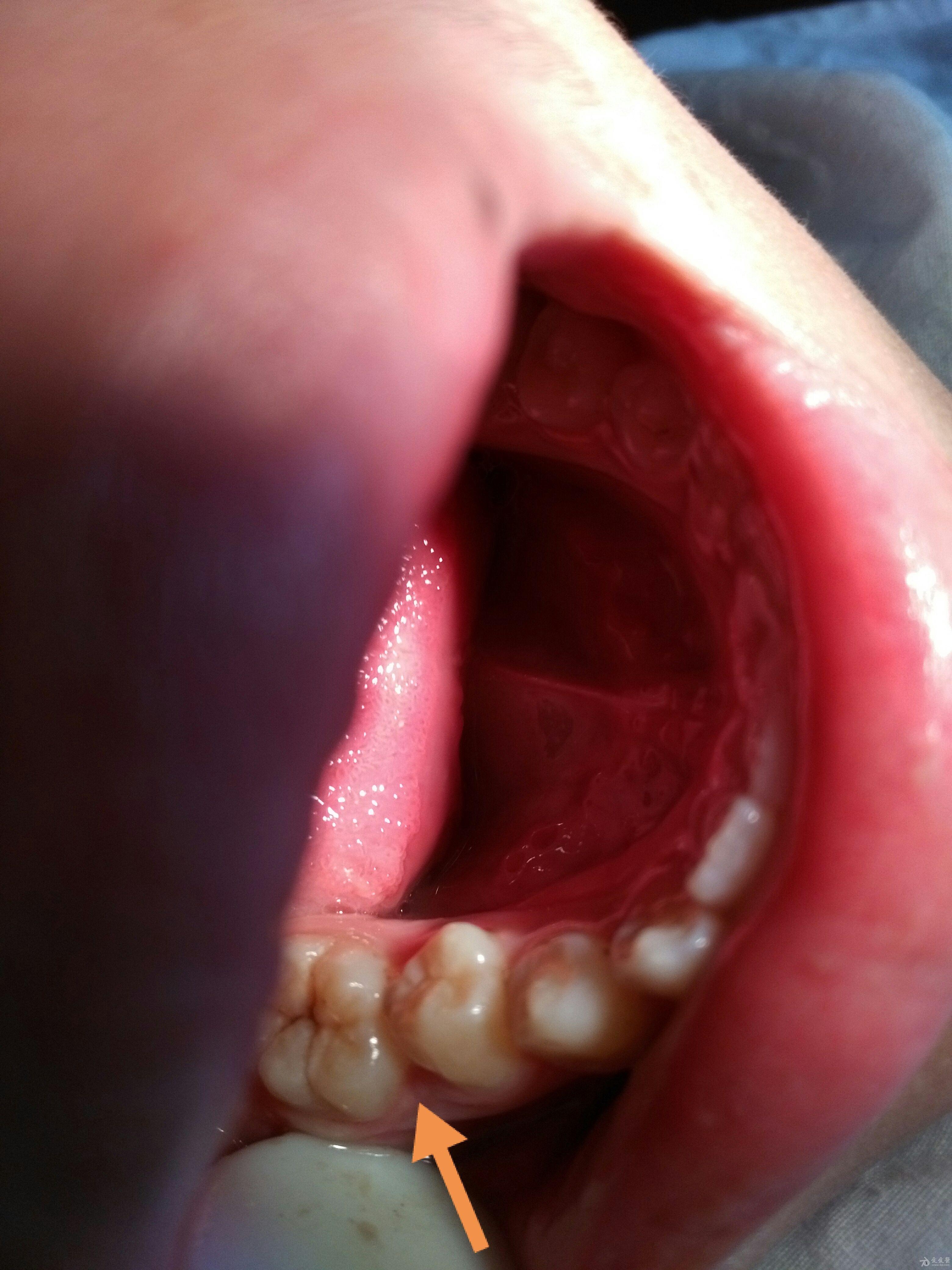 食物嵌塞如何处理