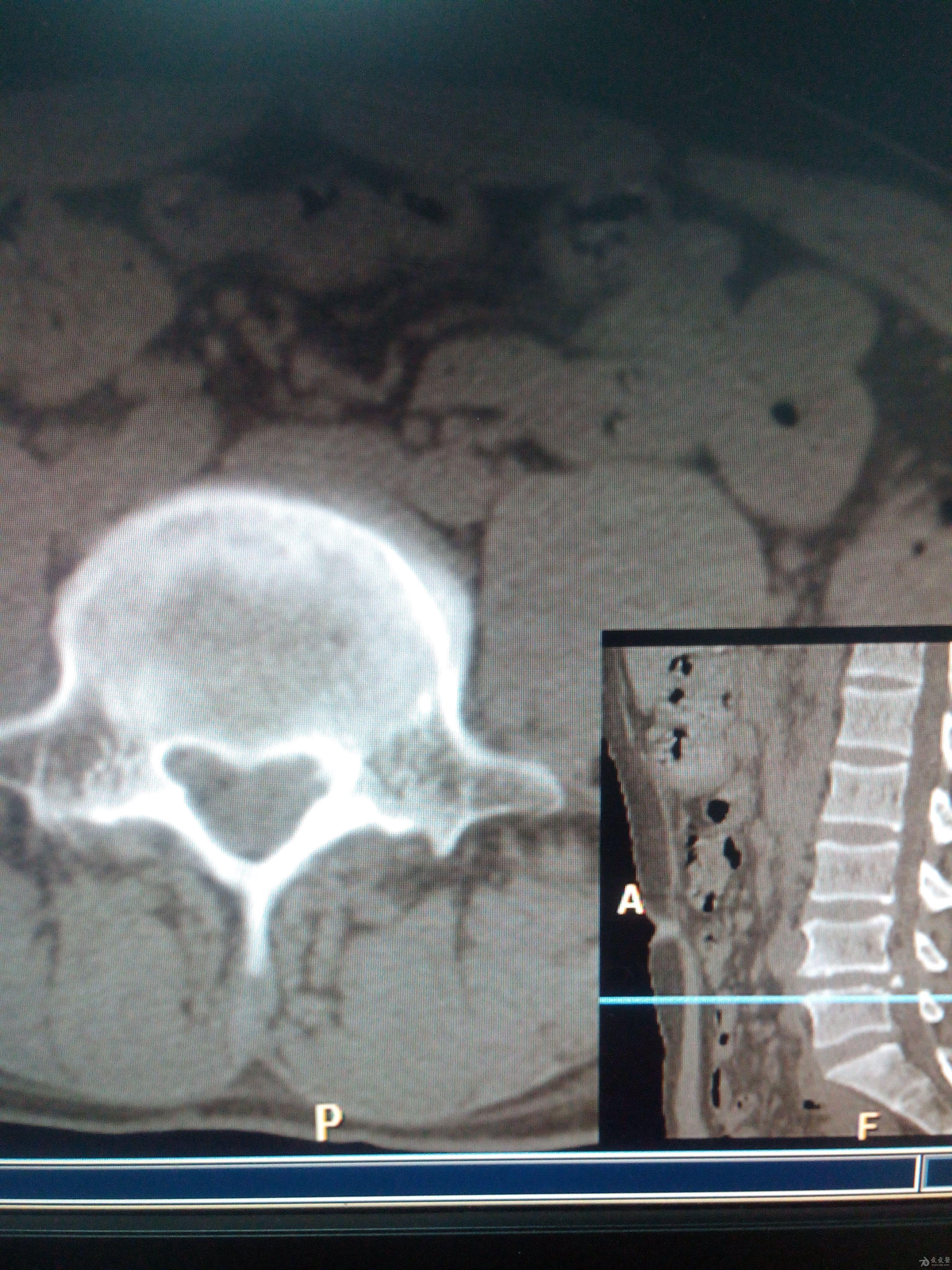 腰椎ct检查请讨论