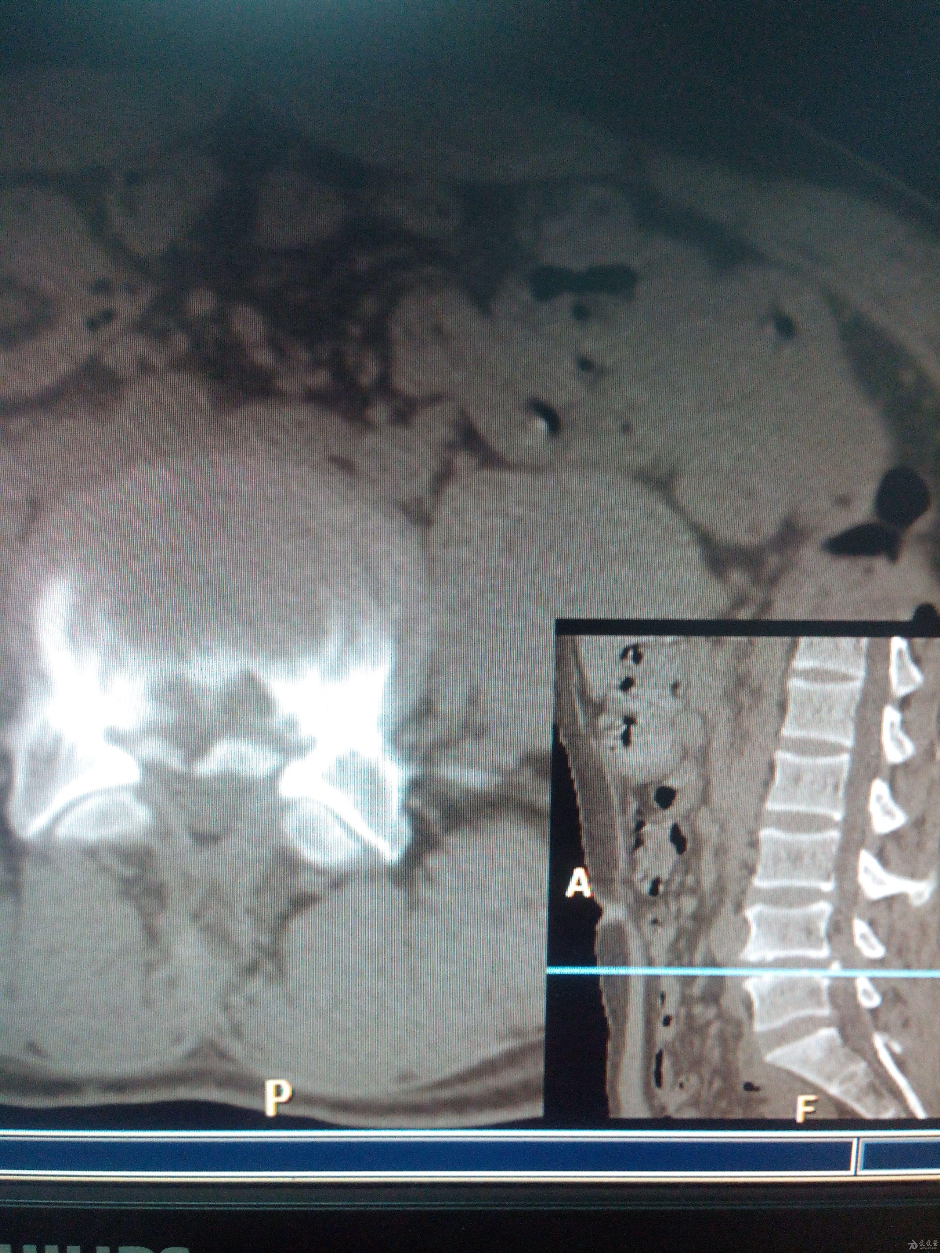 腰椎ct检查,请讨论 医学影像学讨论版 爱爱医医学论坛