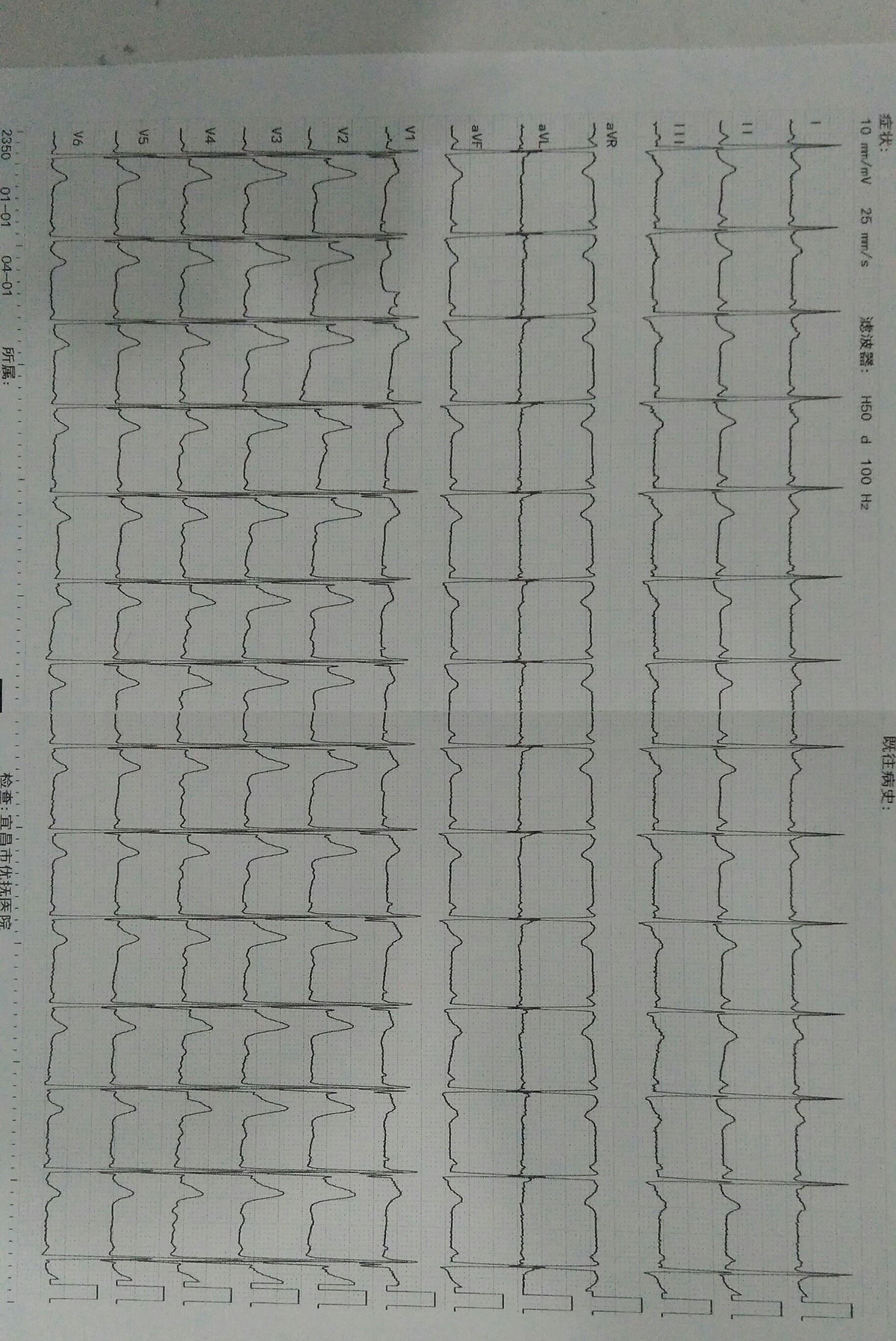 这副图qrs波群后半部分有异常