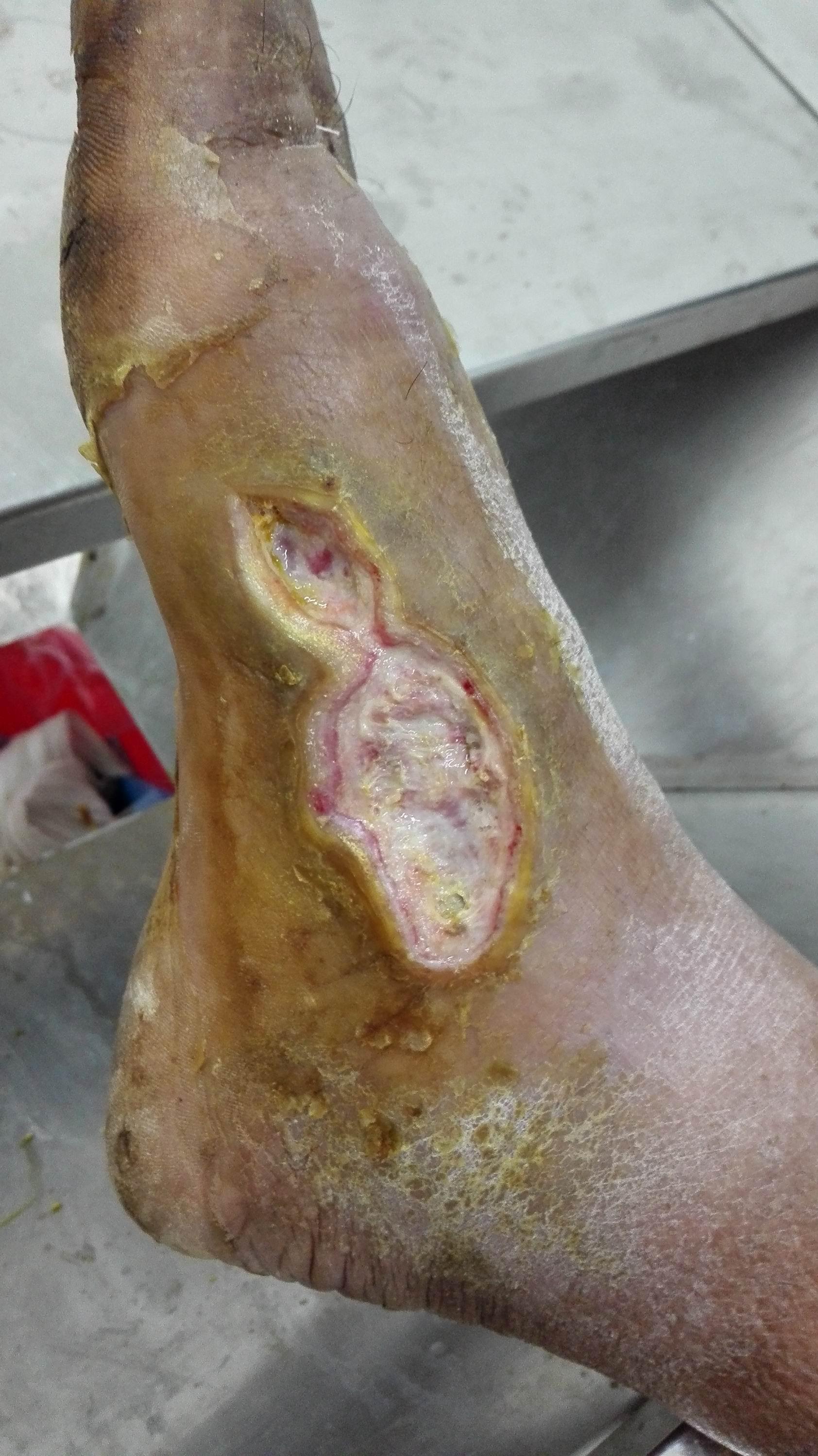 伤口新鲜肉芽组织图片图片