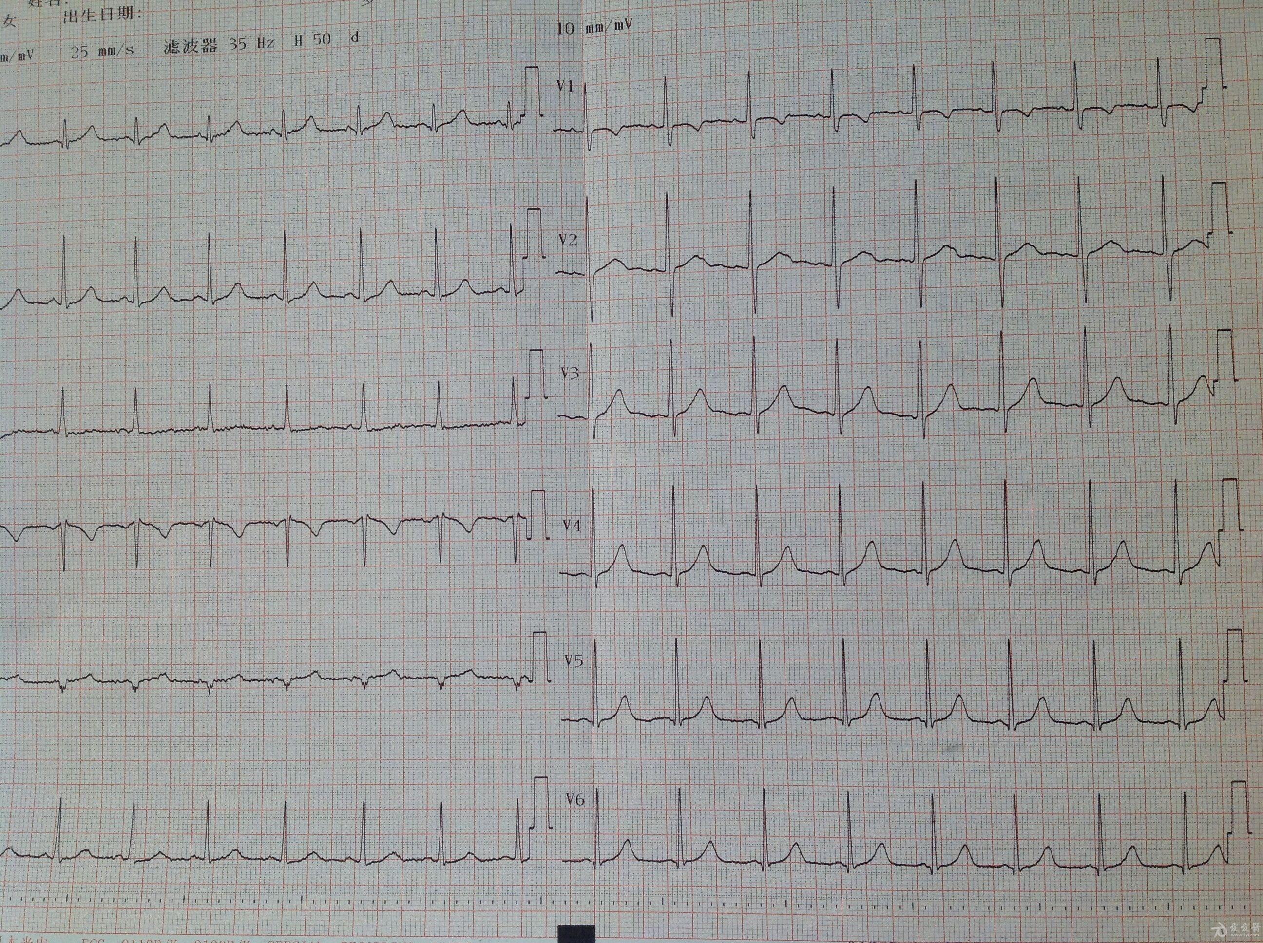正常心电图v1导联t波图片
