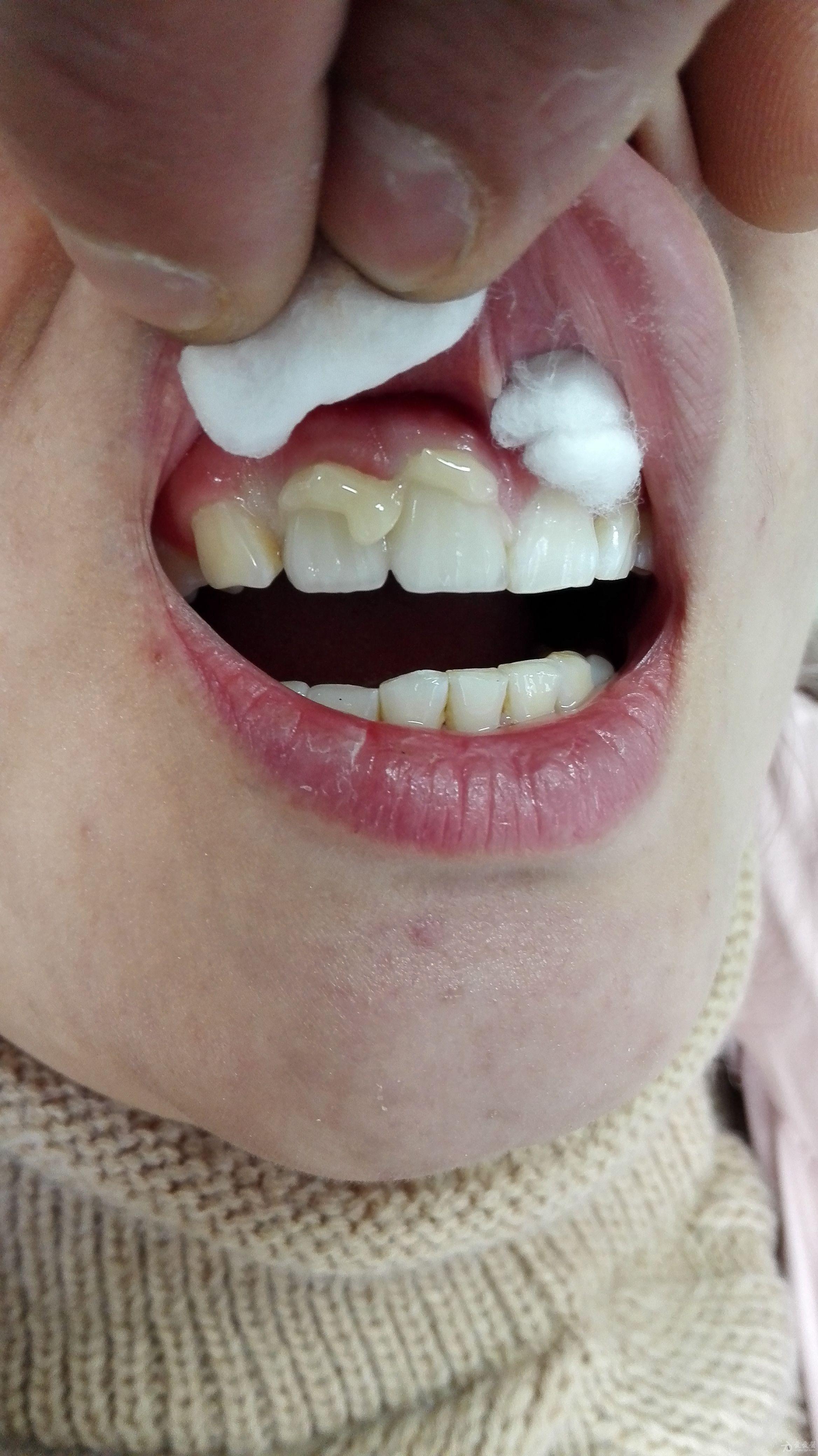 前牙间隙大唇向移位不良修复体病例
