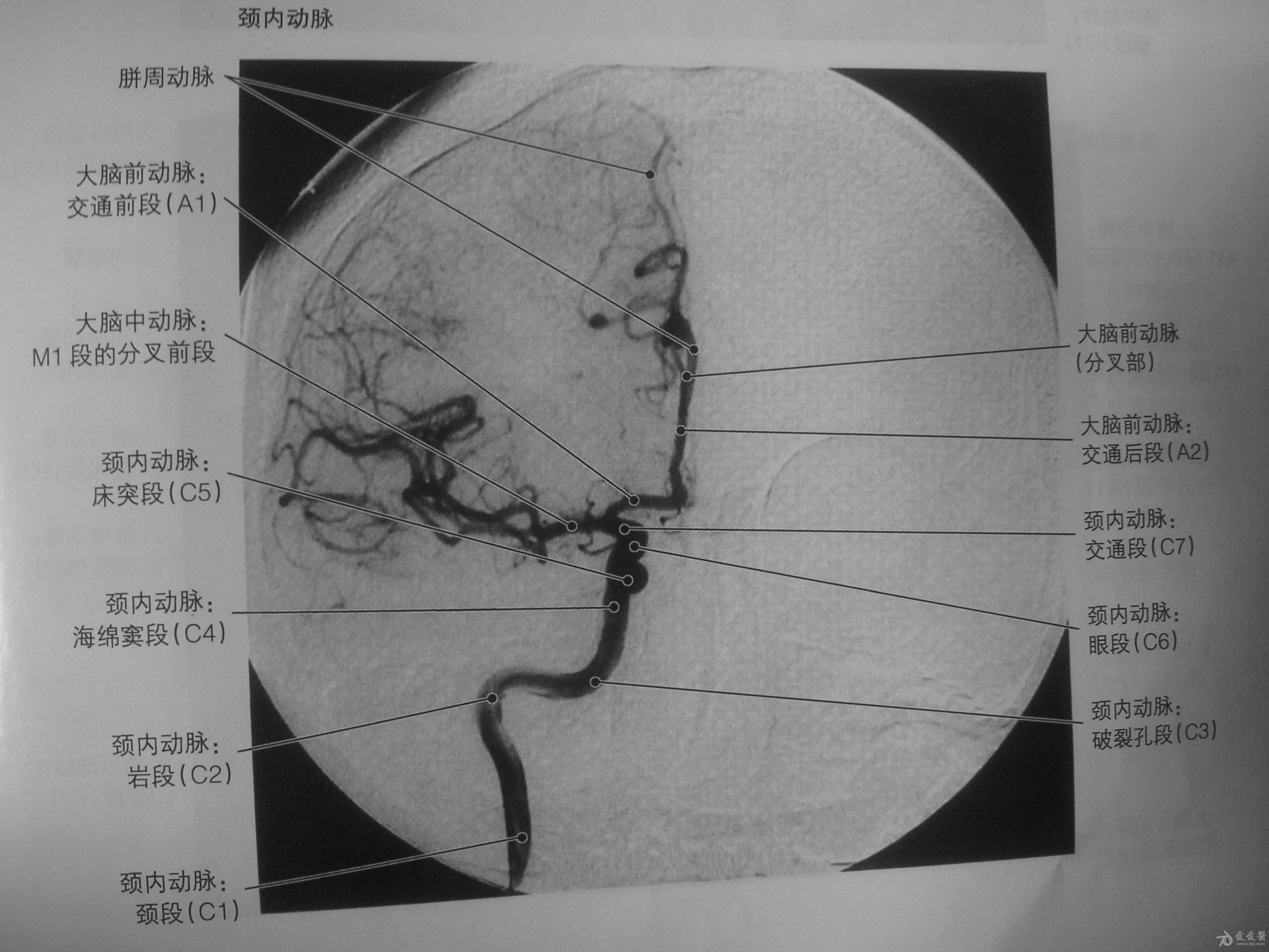 颅内动脉分析 