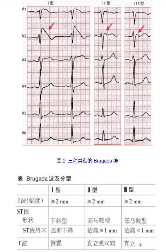 brugada波心电图图片