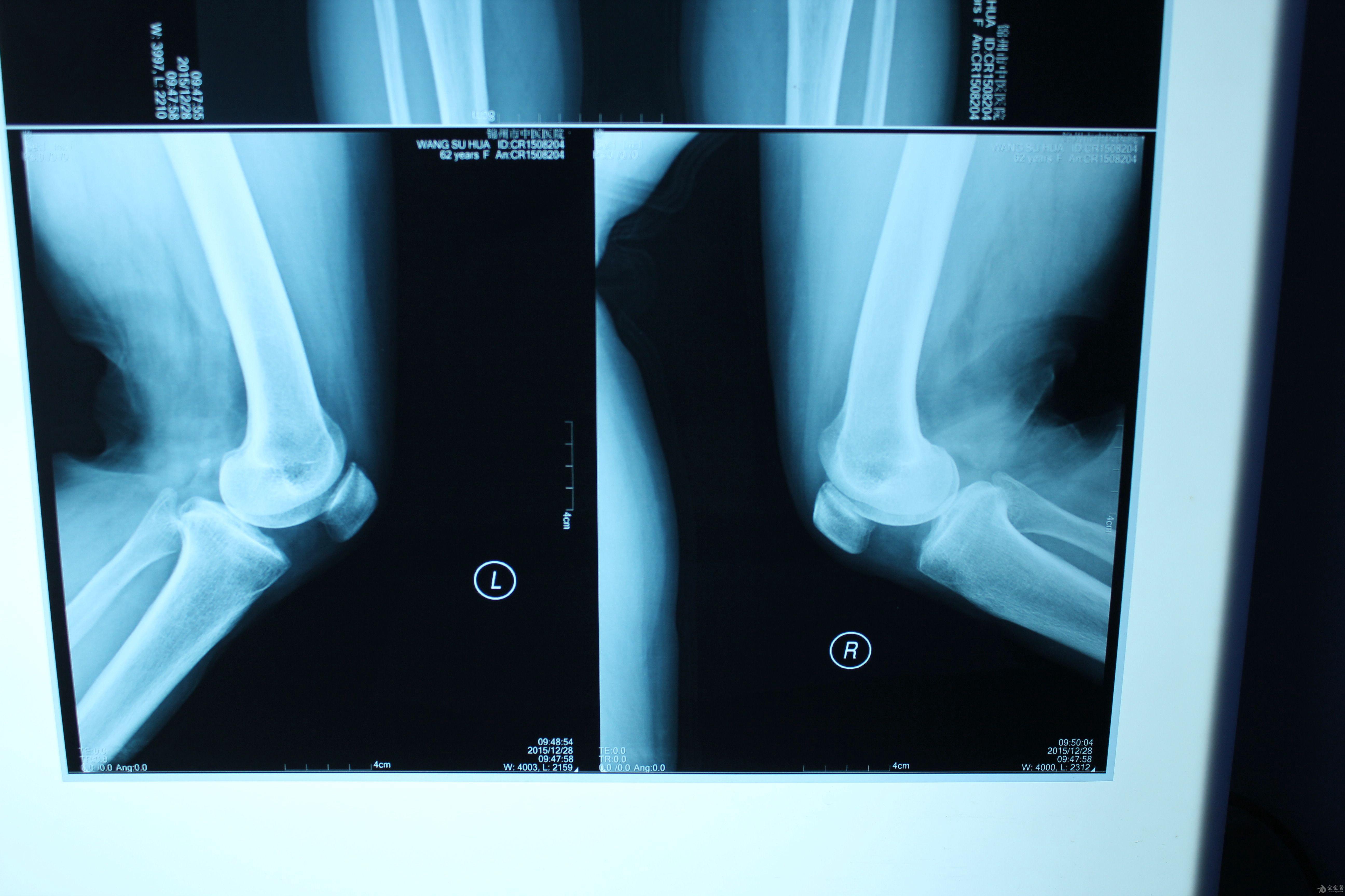 右膝关节扭伤疼痛,活动受限20天(答