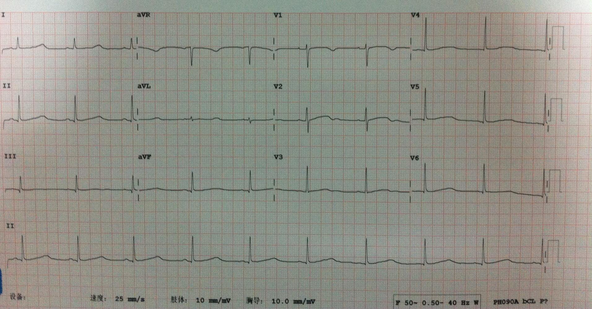 qt间期延长? - 心电图脑电图专业讨论版 - 爱爱医医学论坛