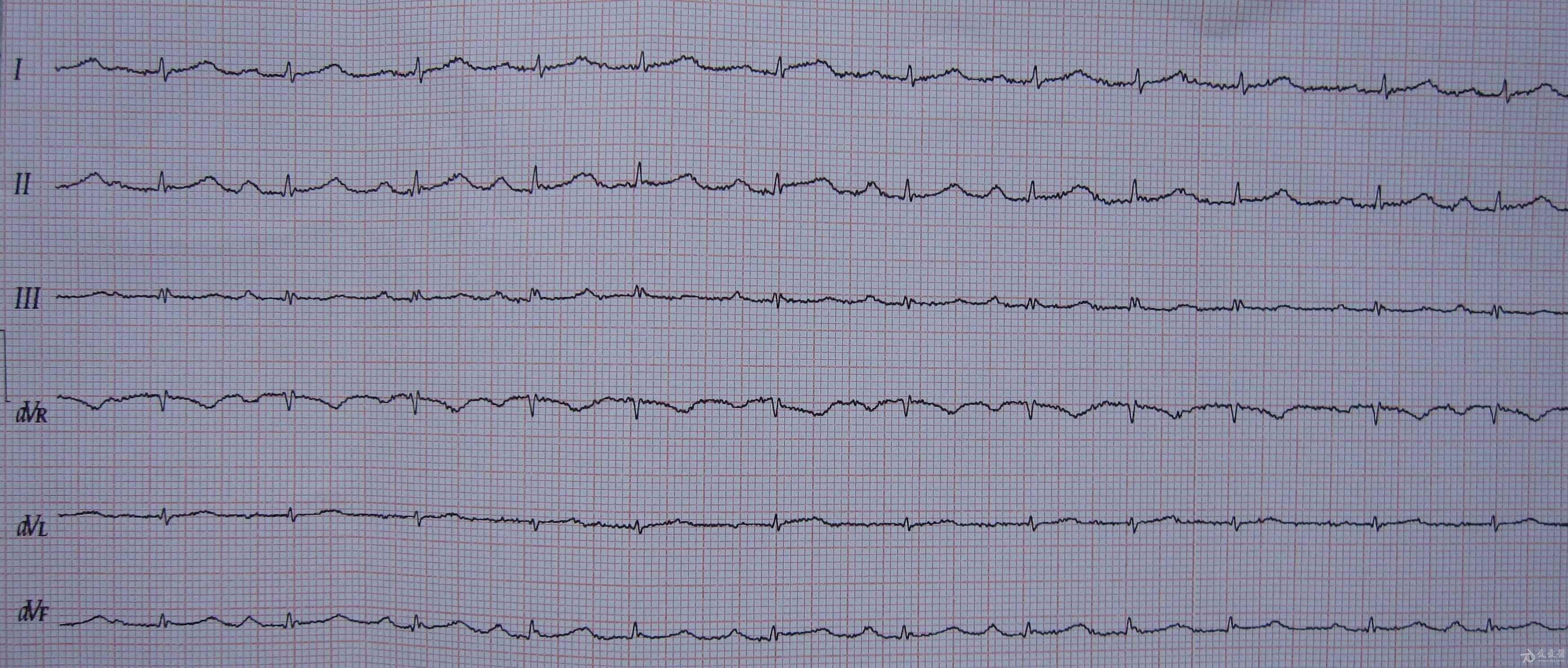 请教各位老师一份老年慢阻肺患者心电图
