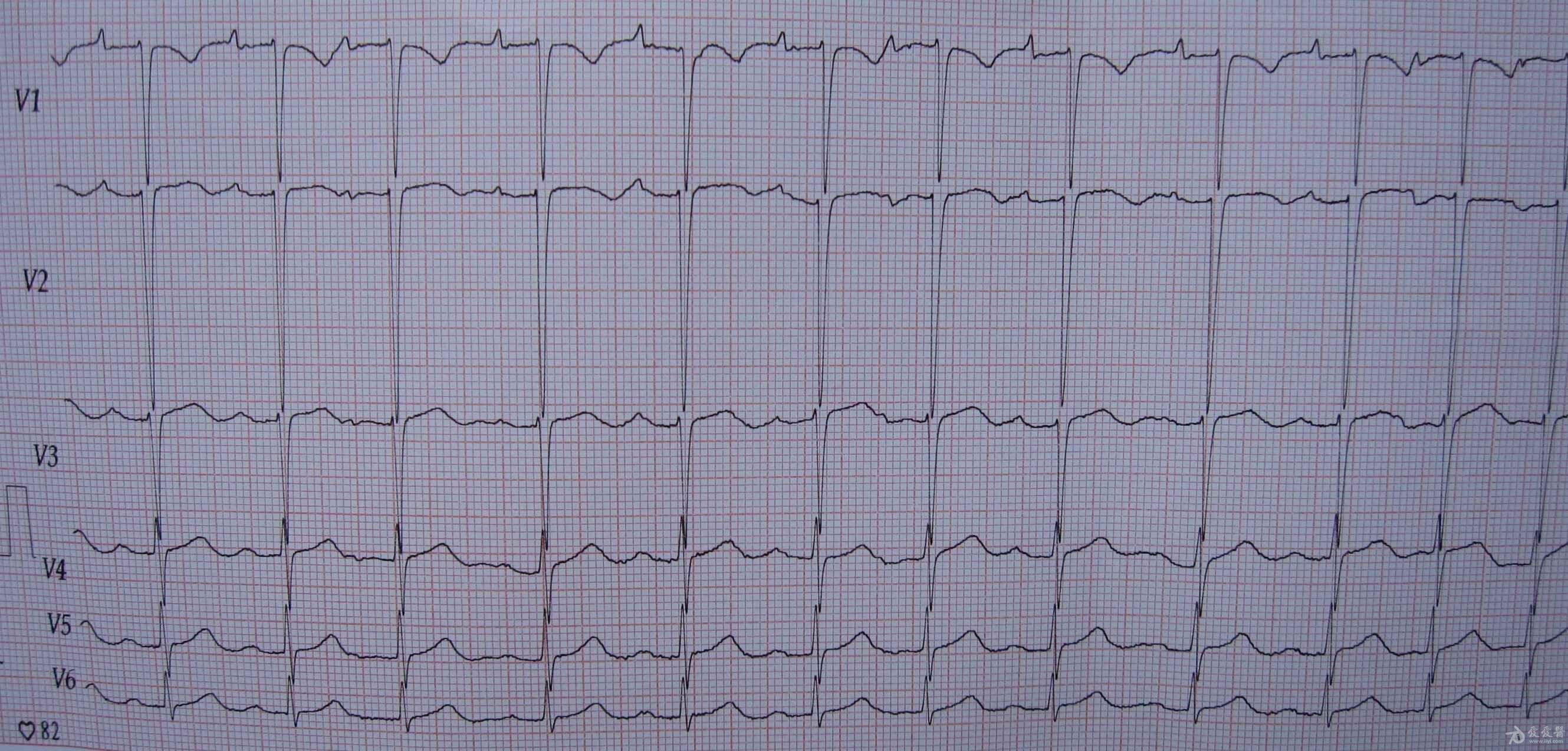请教各位老师一份老年慢阻肺患者心电图