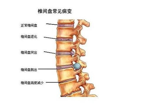 什么是腰间盘膨出、突出、脱出