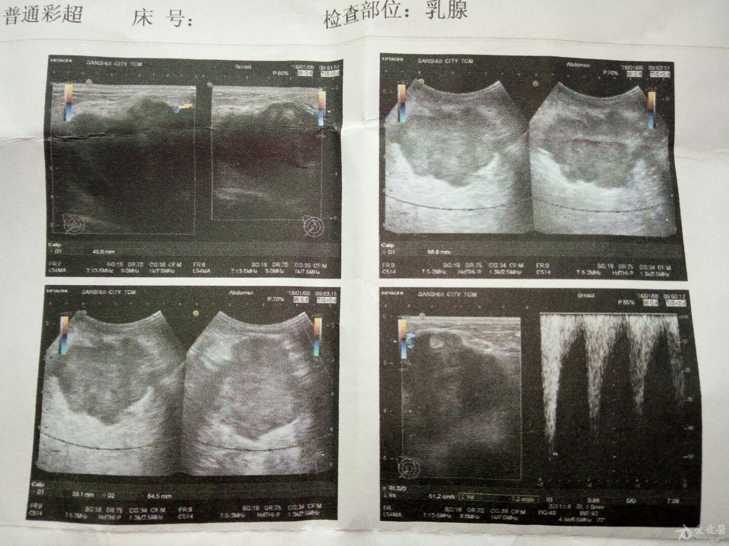 乳腺腫塊是良性還是惡性