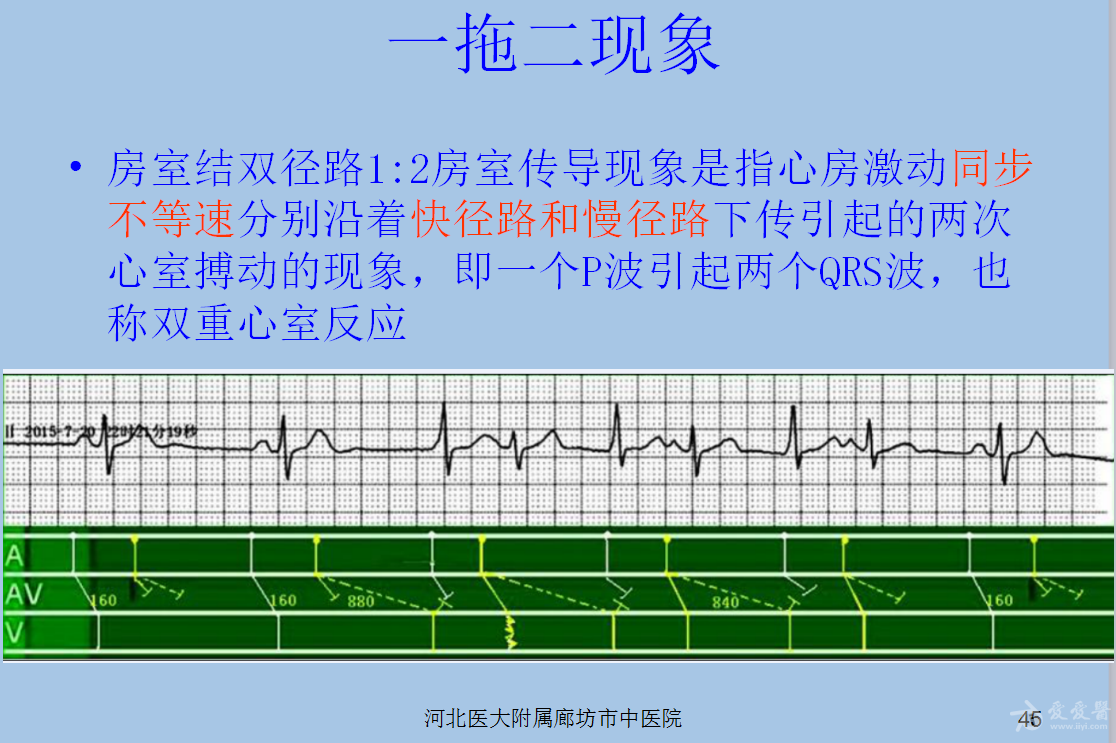 房室结双径路图片