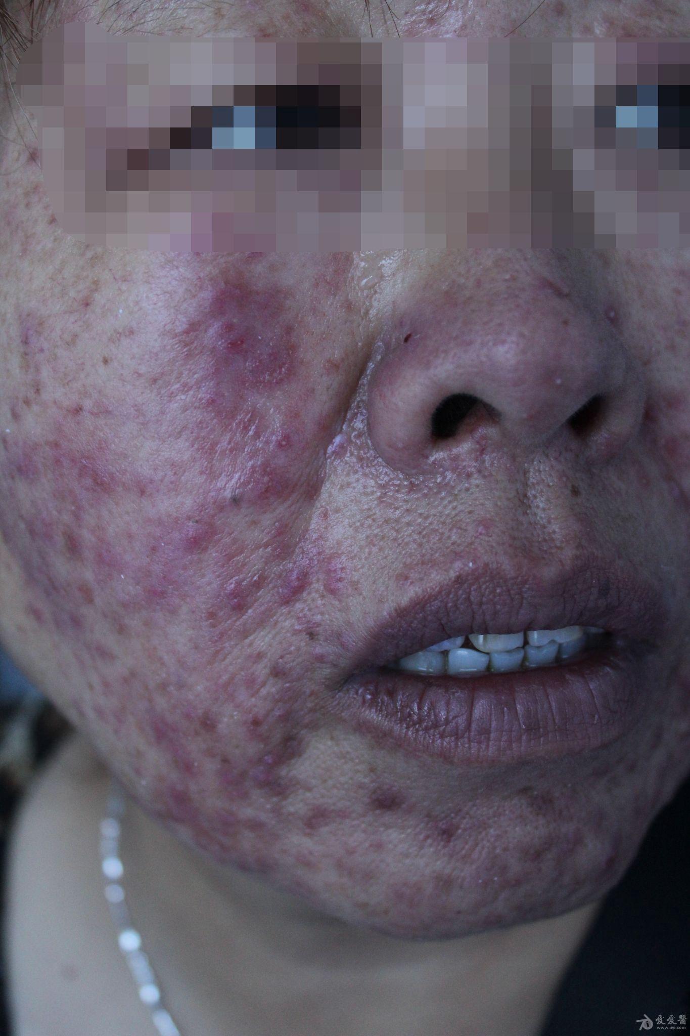 刘某女55岁面颊部突然起大量疱疹