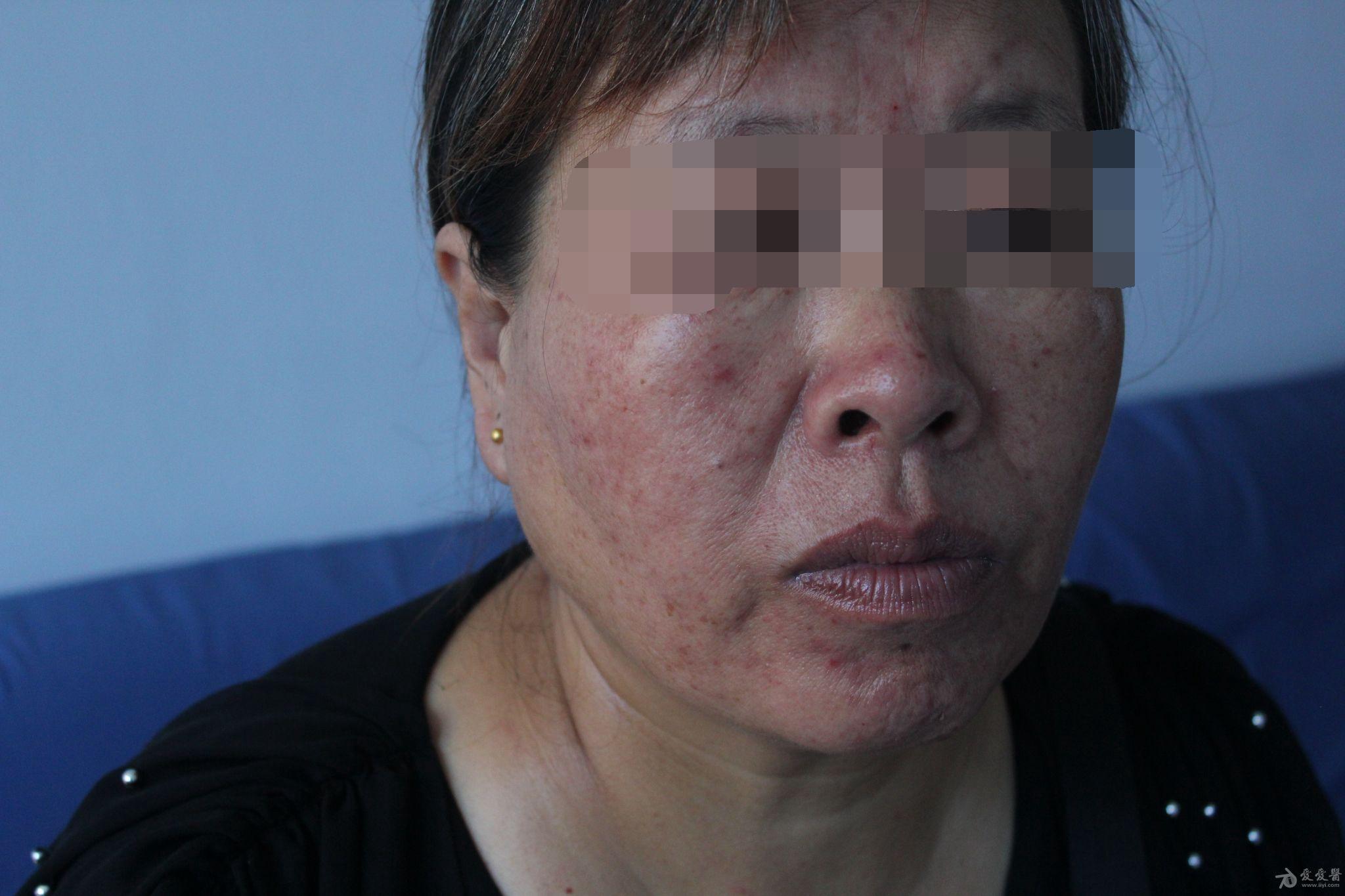 刘某,女55岁,面颊部突然起大量疱疹