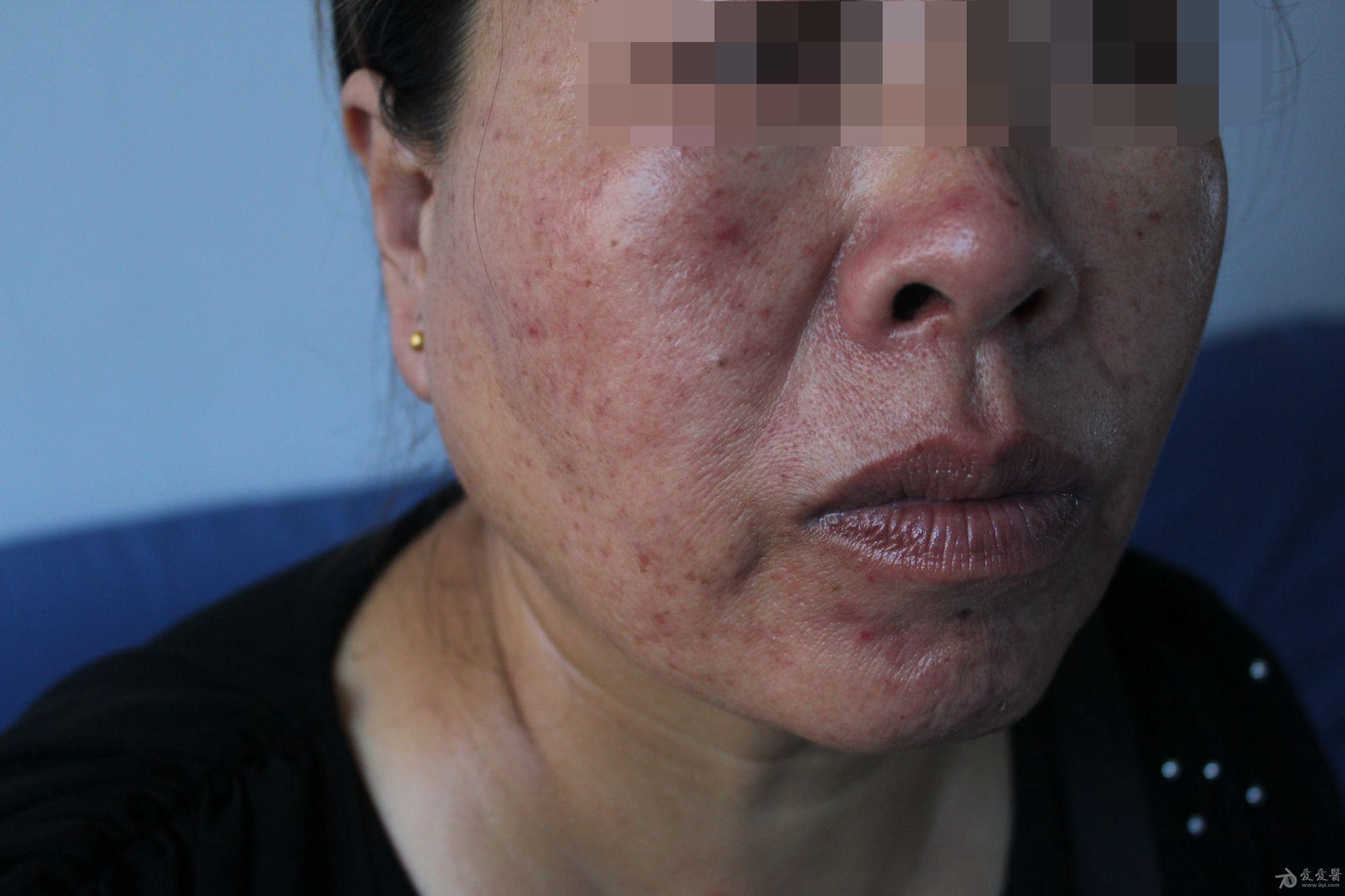 刘某女55岁面颊部突然起大量疱疹