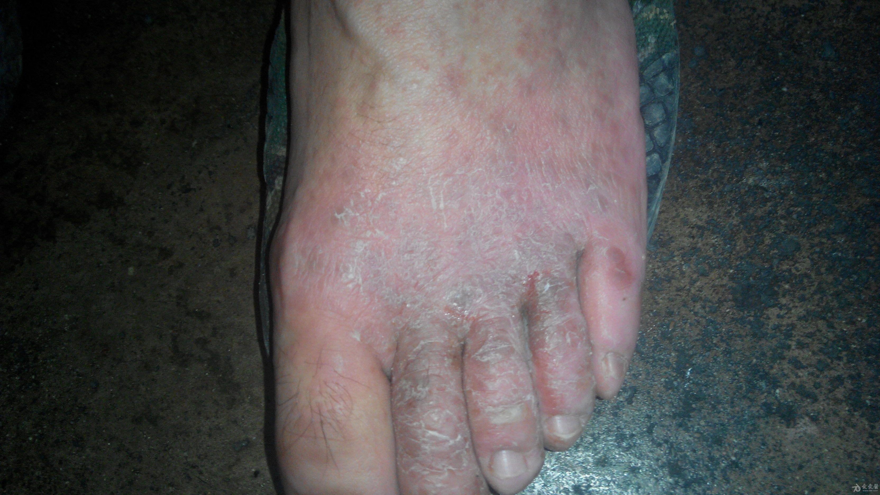 窝状角质松解症浸渍糜烂型足癣癣菌疹