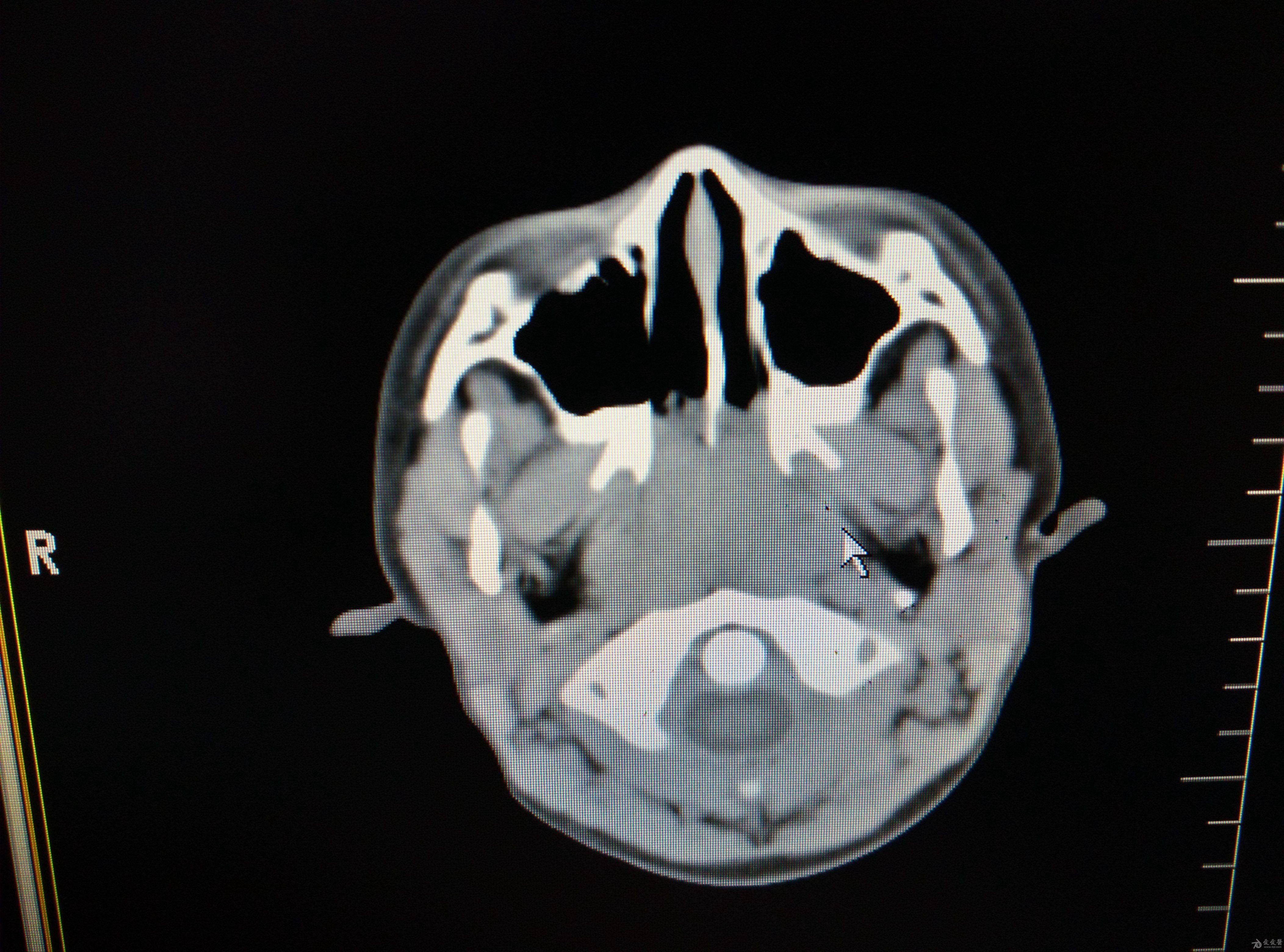 腺样体ct片子图片图片