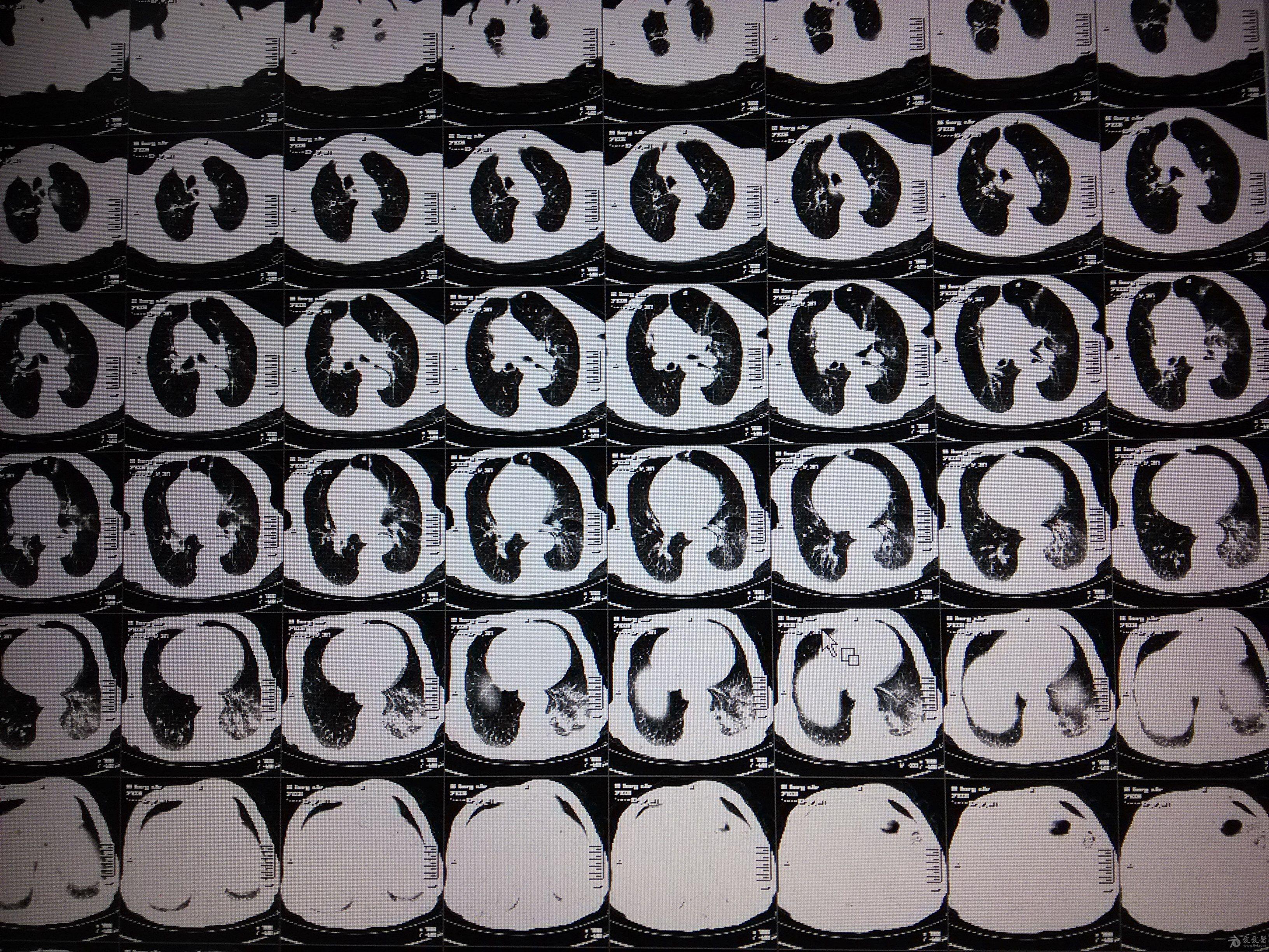 迎新年全科版病例分享第19期突发短时间心动过速您考虑什么