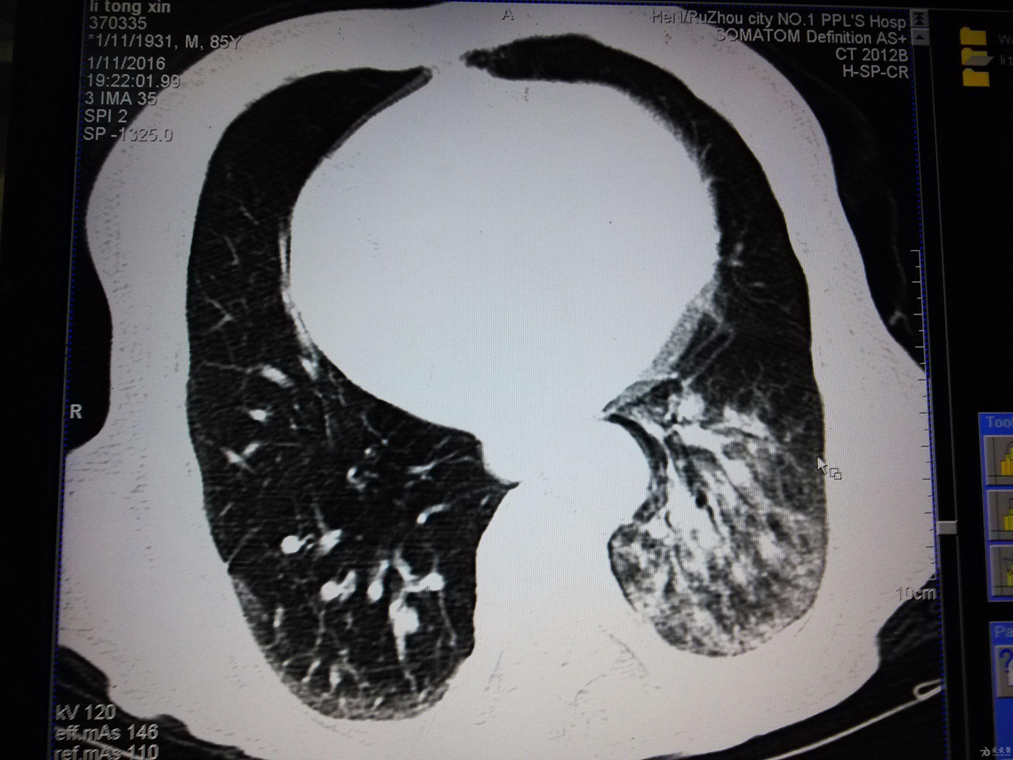 肺炎性假瘤ct表现图片