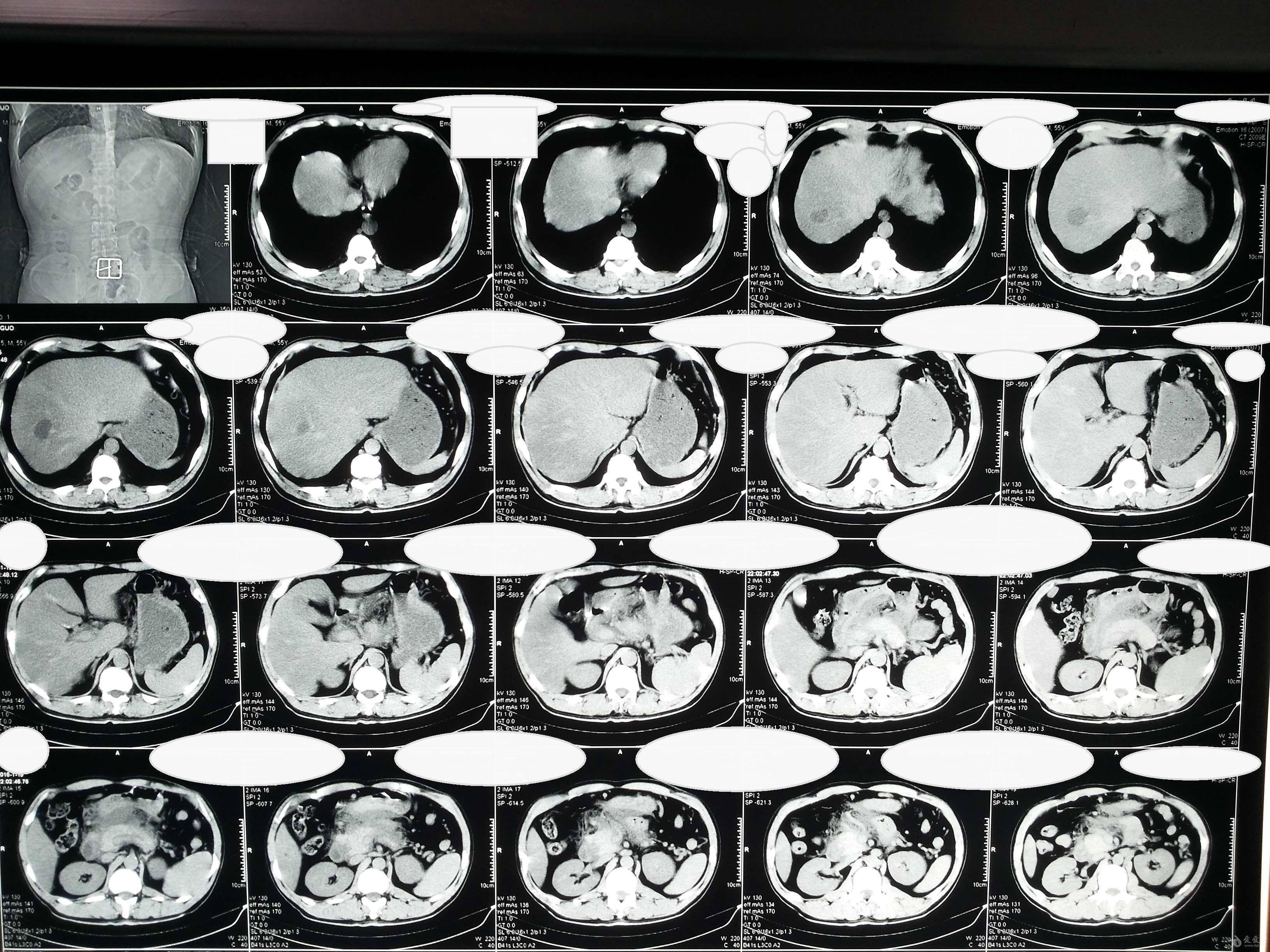 原创间断腹痛2年再发1天附腹部ct