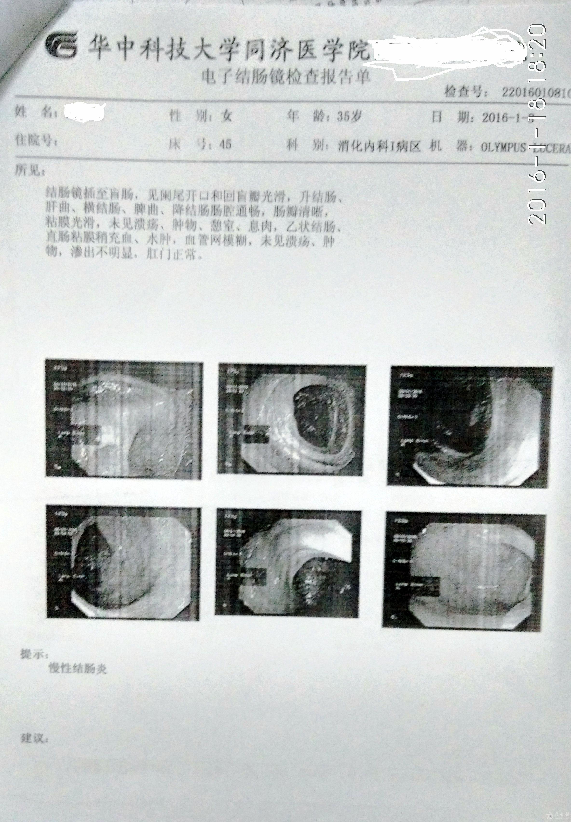 2016年第二次腸鏡檢查