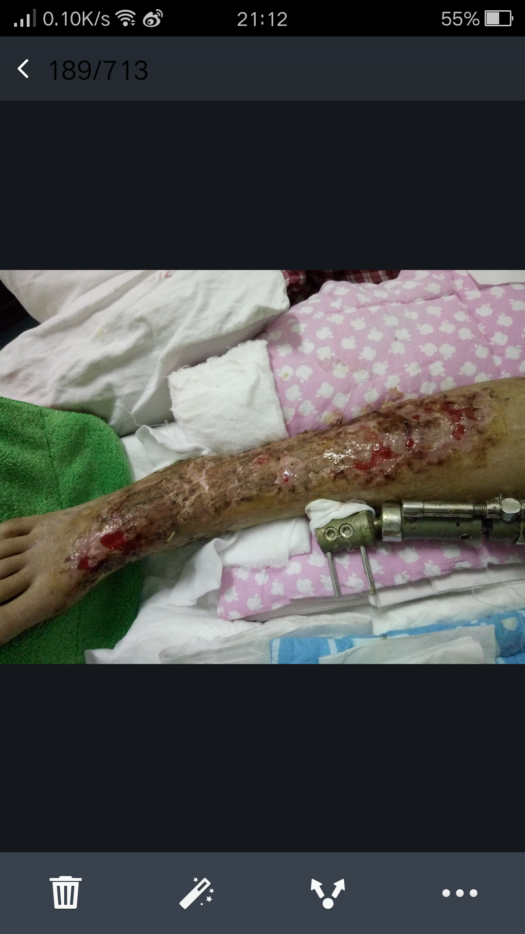 上传一组植皮后久不愈合照片