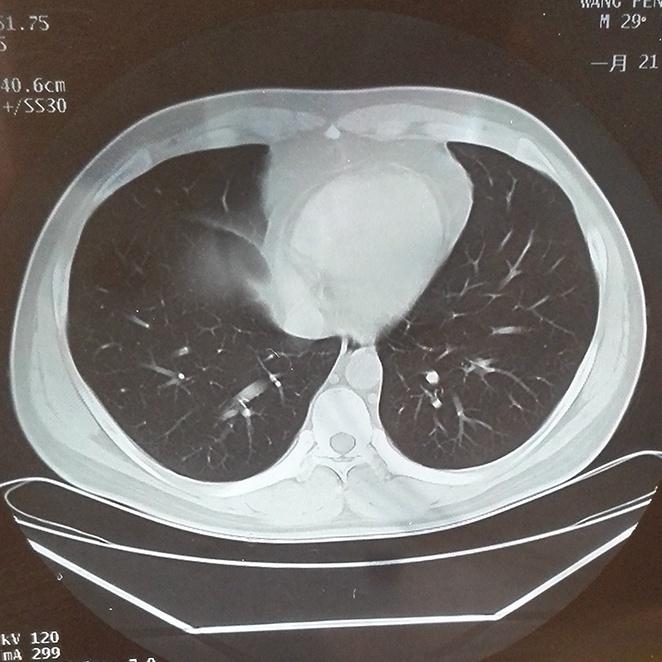 正常肺ct表现图片图片