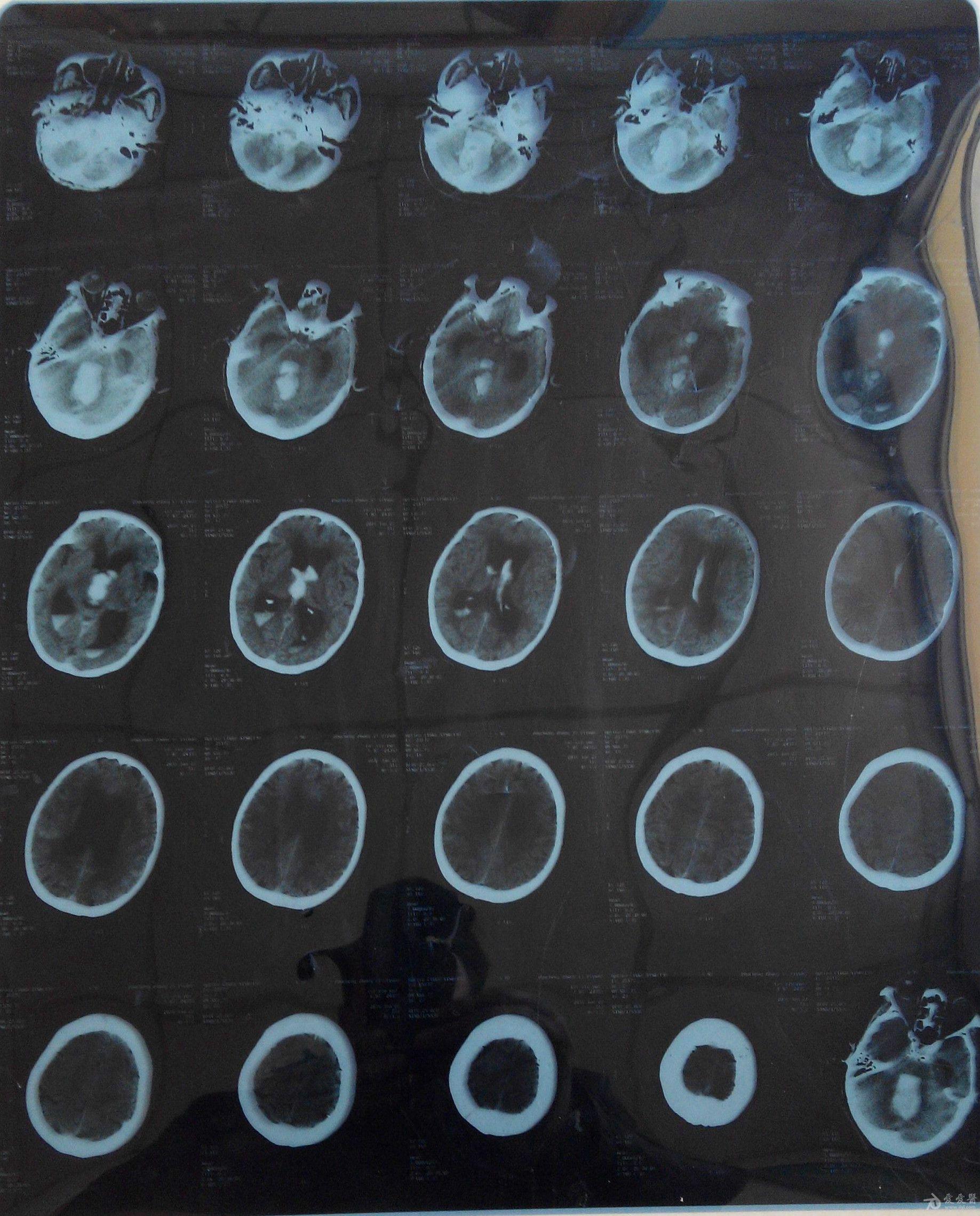 原创头痛头晕眼花恶心呕吐